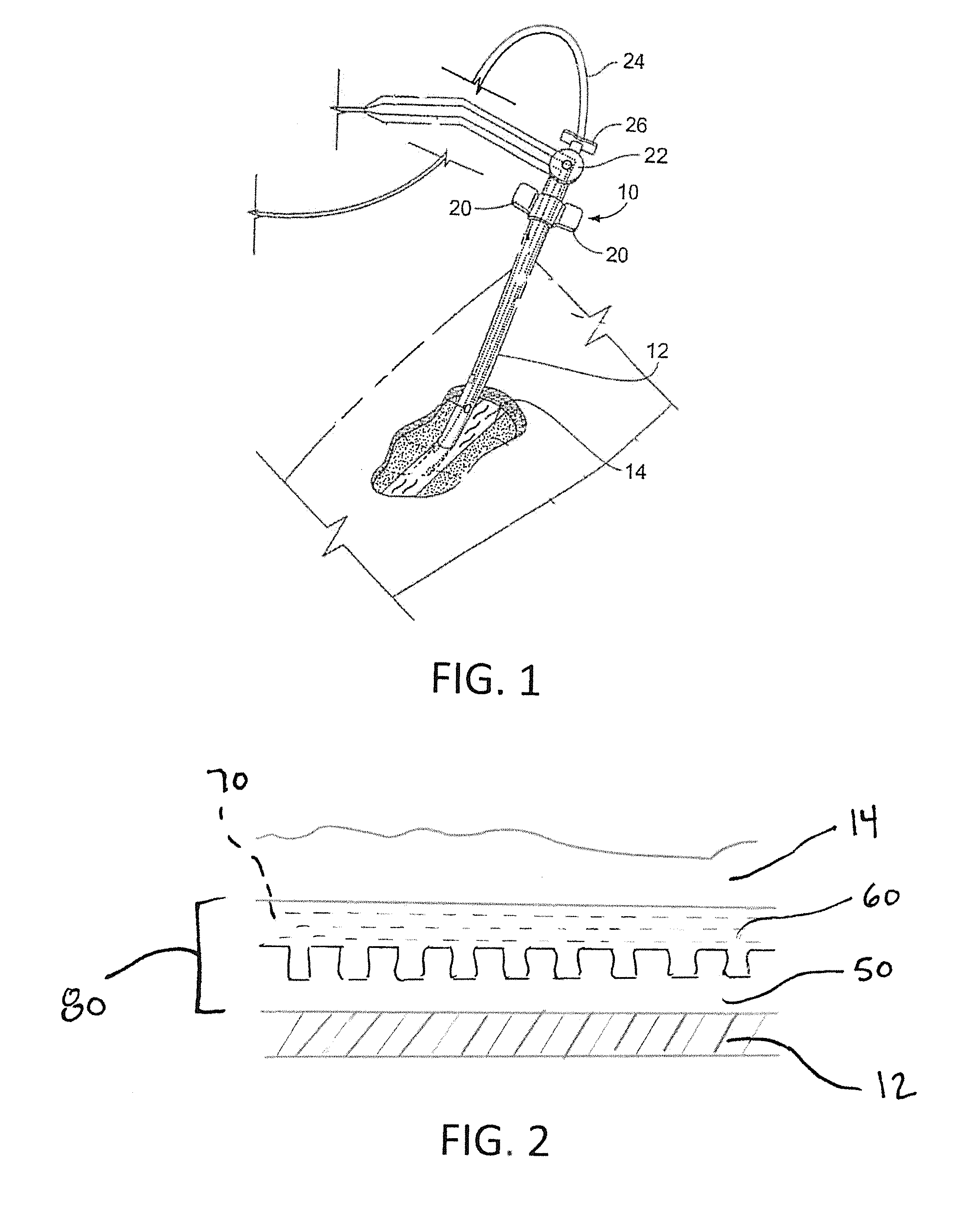 Coated medical device