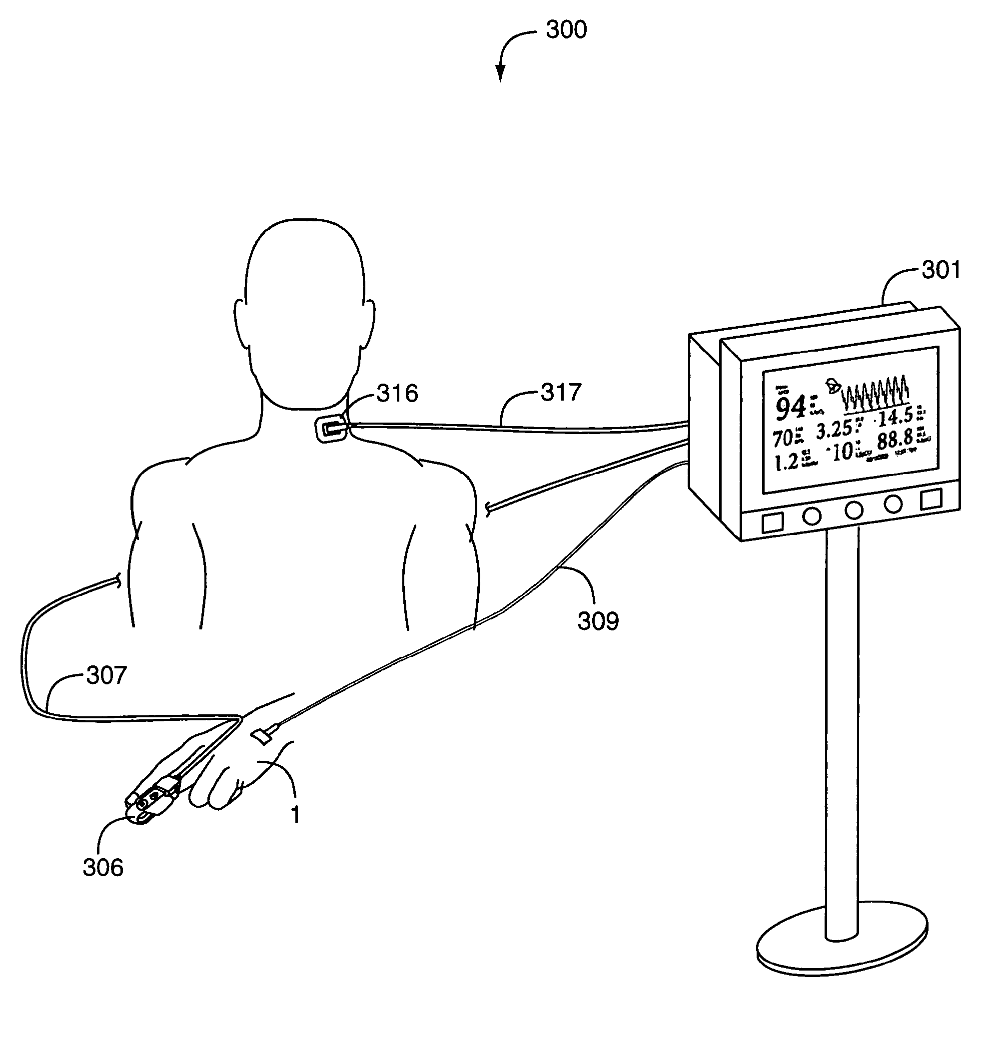 Sepsis monitor