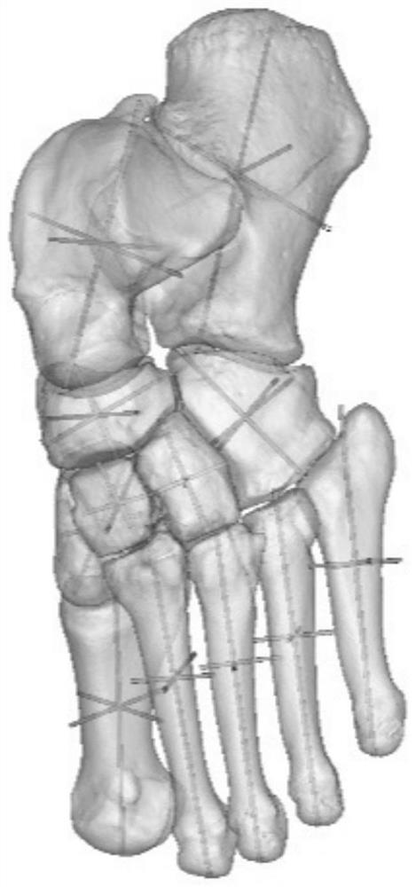 A method for constructing arch-rod structure based on the principal axis of the living bone inertia of the arch of the foot