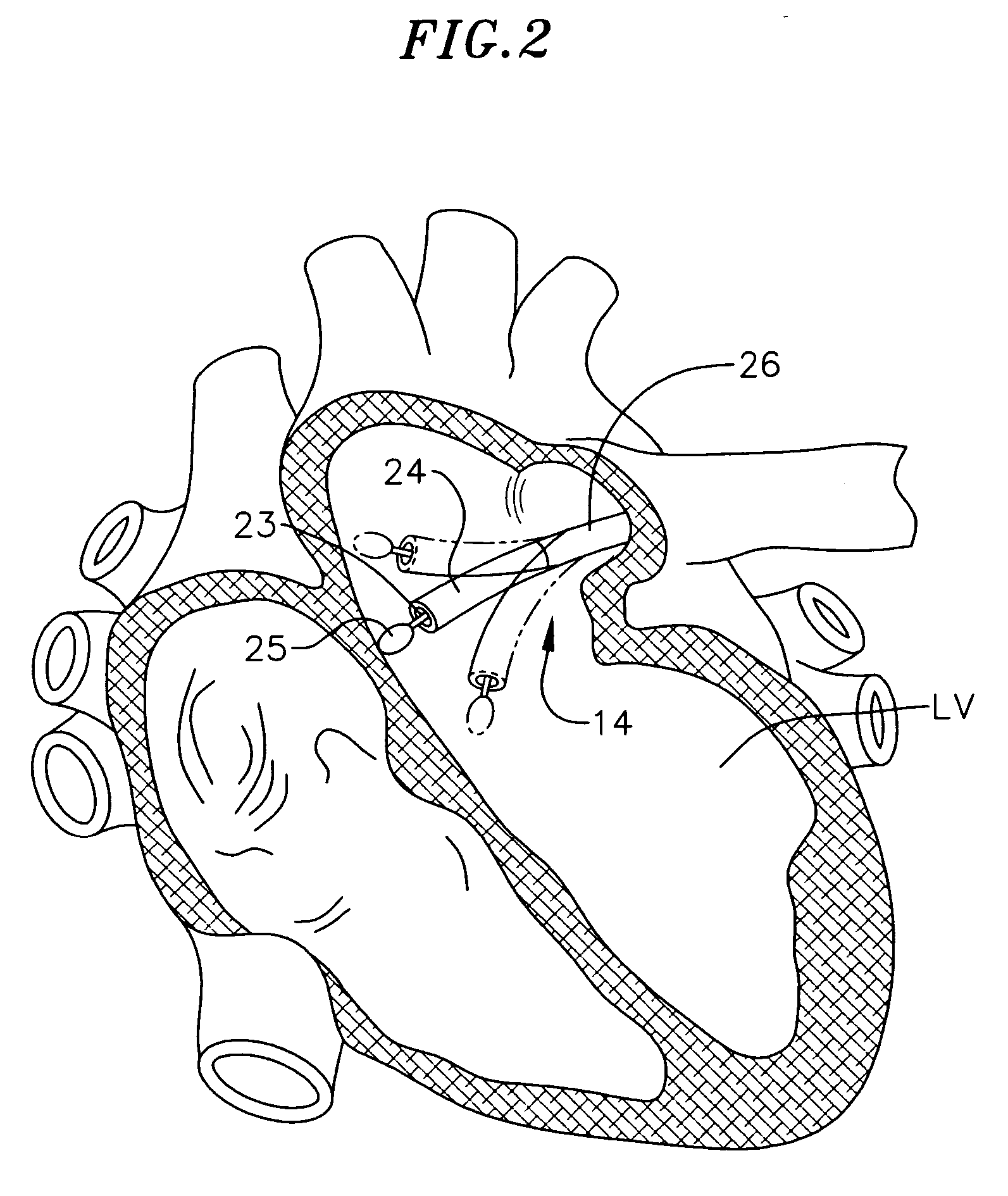 Steerable device for introducing diagnostic and therapeutic apparatus into the body