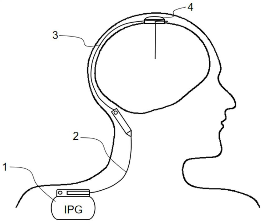 Electrode locking device