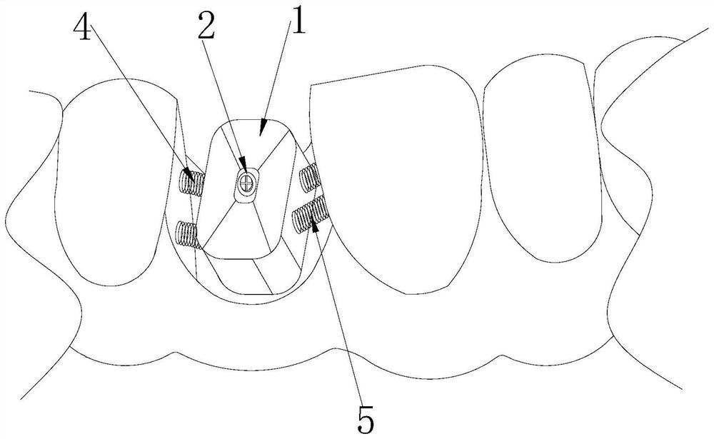 Personalized healing and correction abutment for implant upper part and preparation method thereof