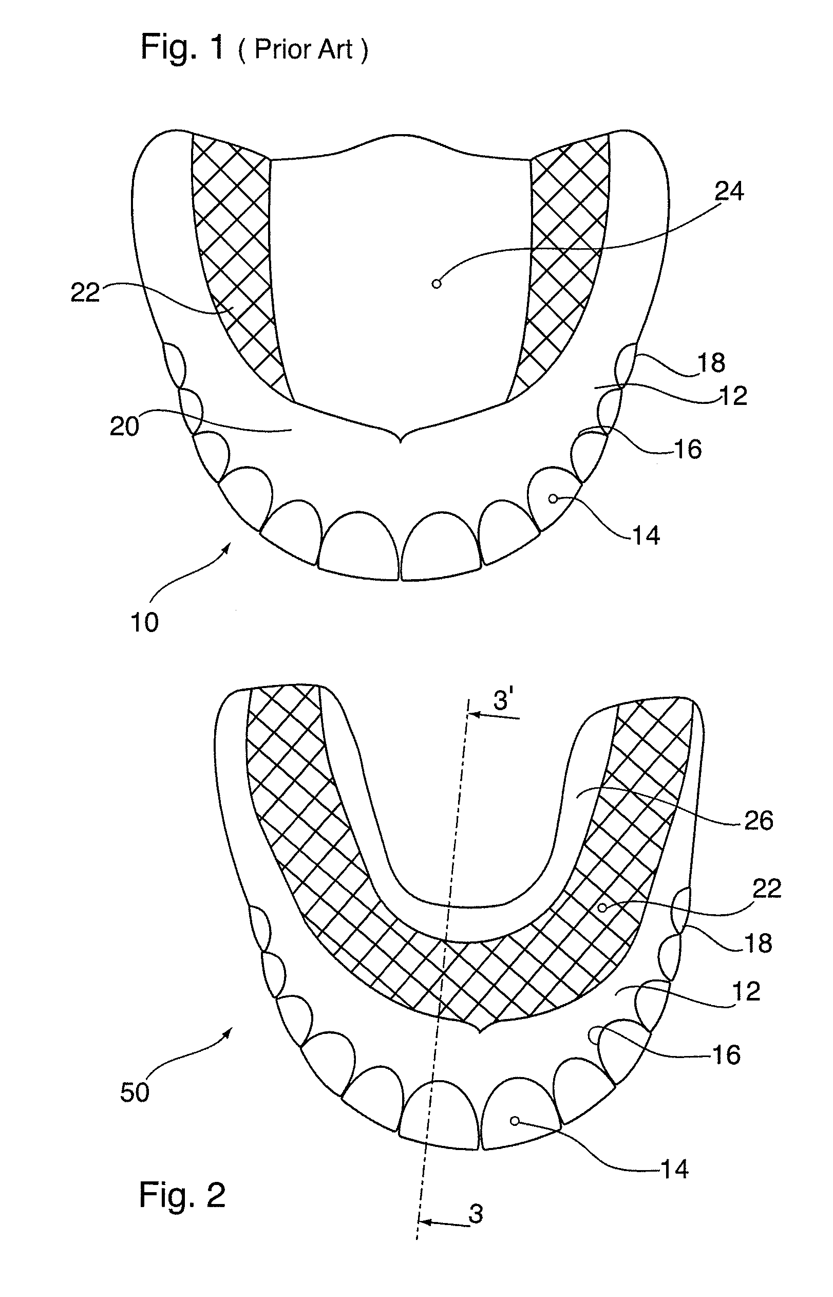 Palate-Free Upper Denture