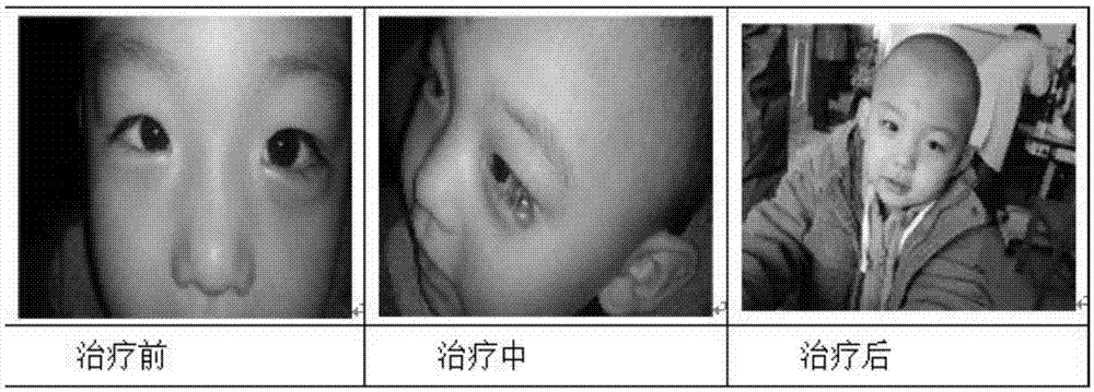 Traditional Chinese medicine composition for treating chalazia and preparation method thereof