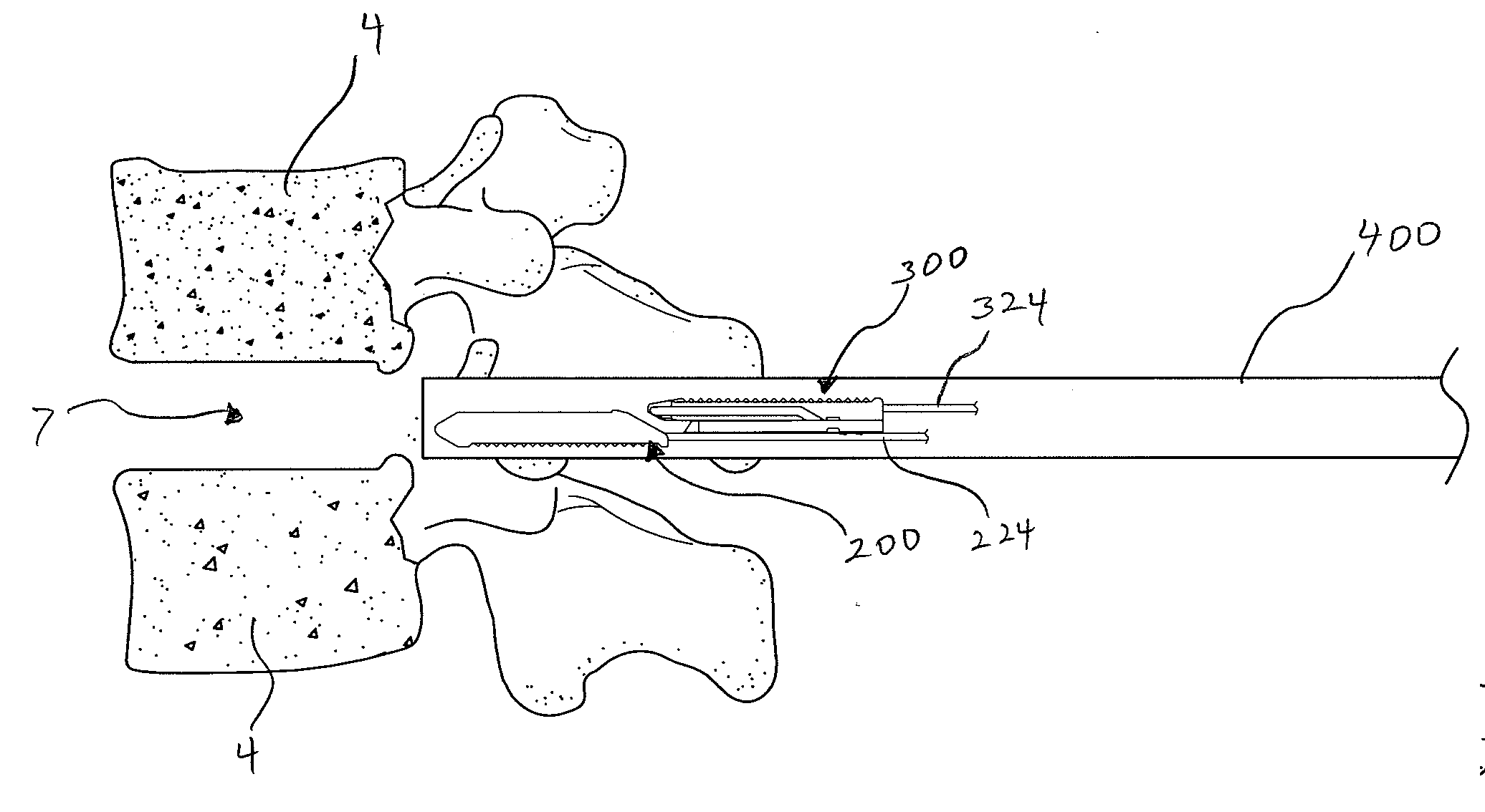 Intervertebral implant