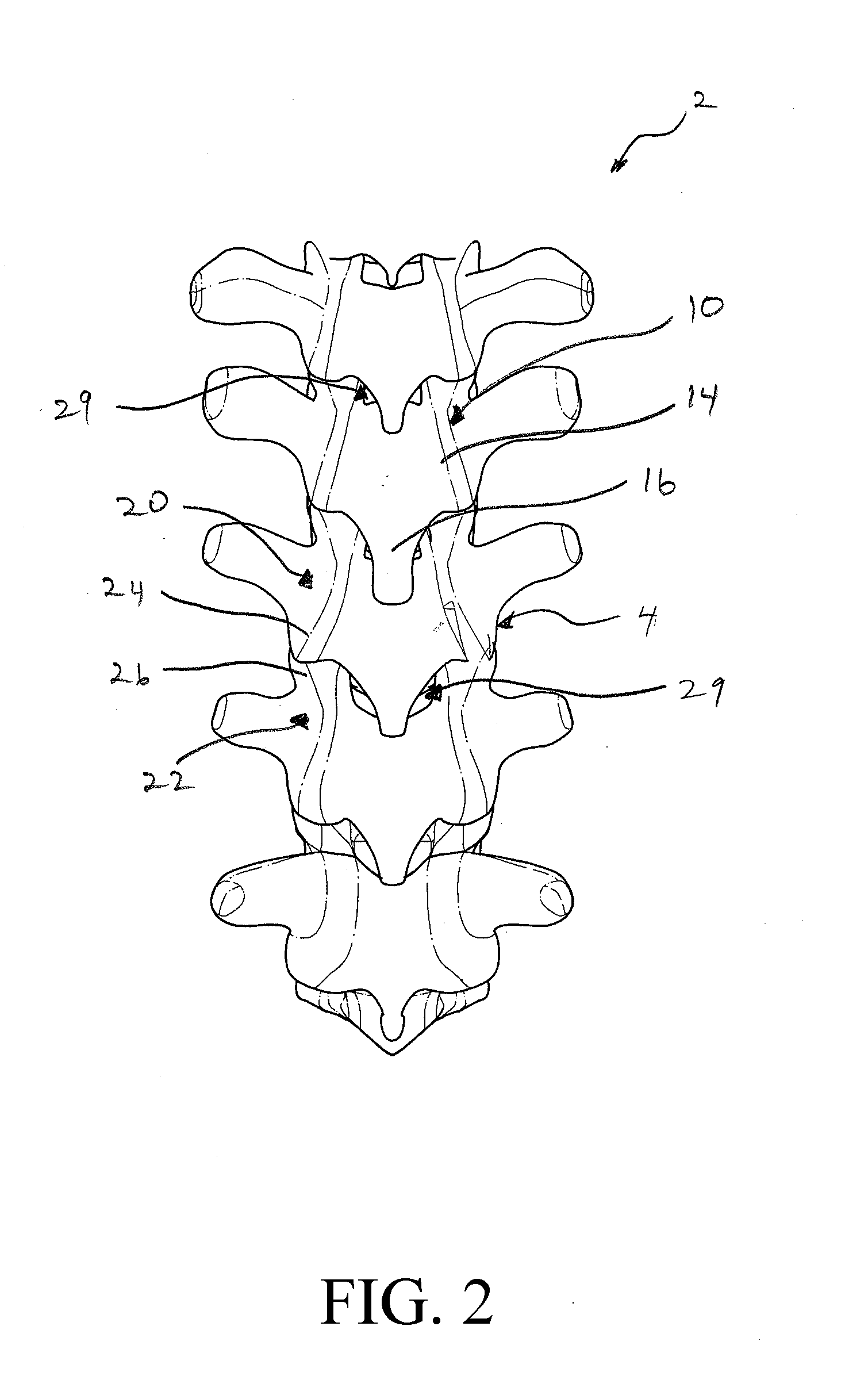 Intervertebral implant