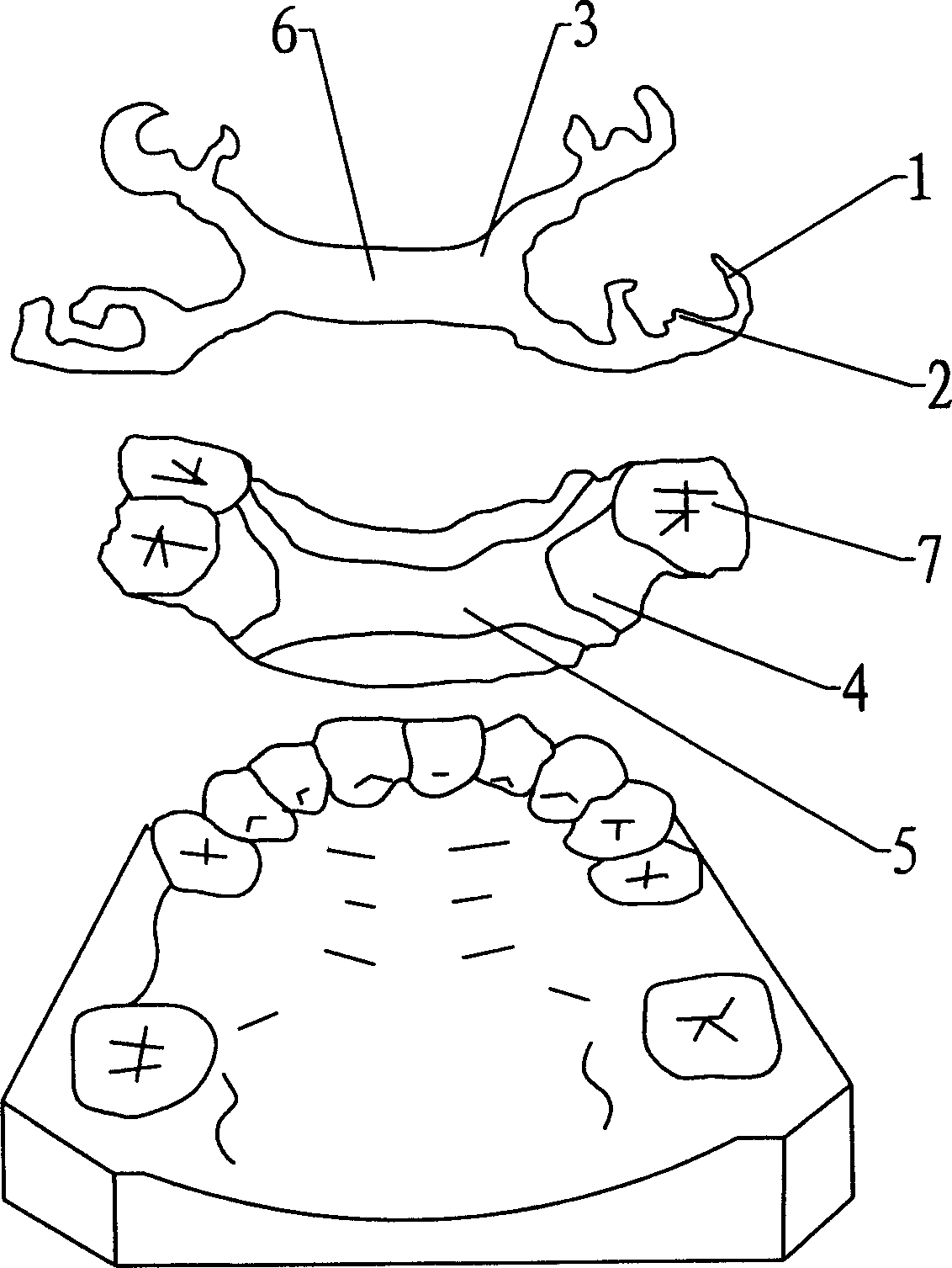 Removable local artificial tooth and its making method