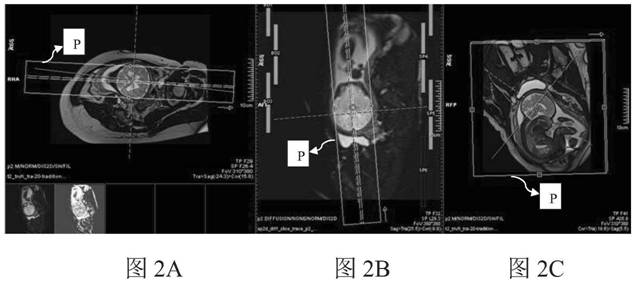 Method for measuring fetal corpus callosum volume by using magnetic resonance imaging, and magnetic resonance imaging apparatus