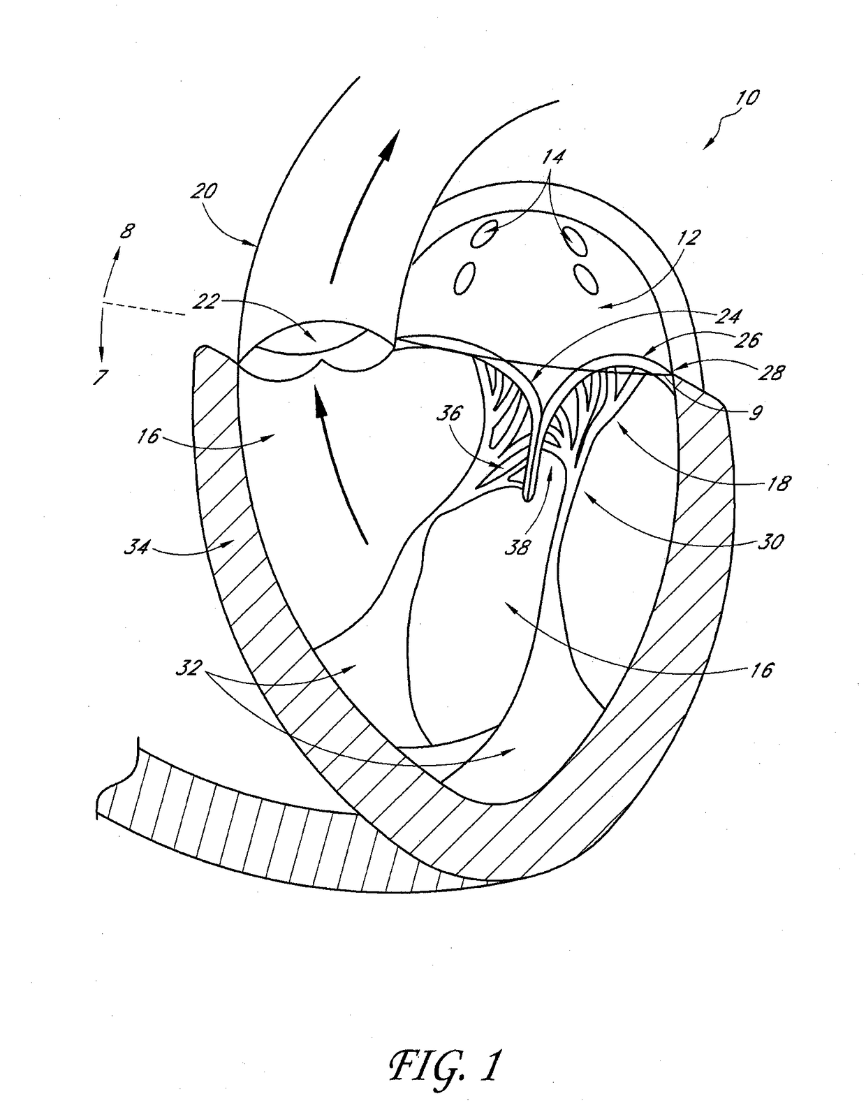 Transvalvular intraannular band for mitral valve repair