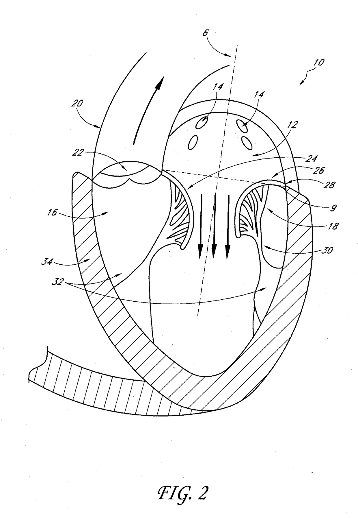 Transvalvular intraannular band for mitral valve repair