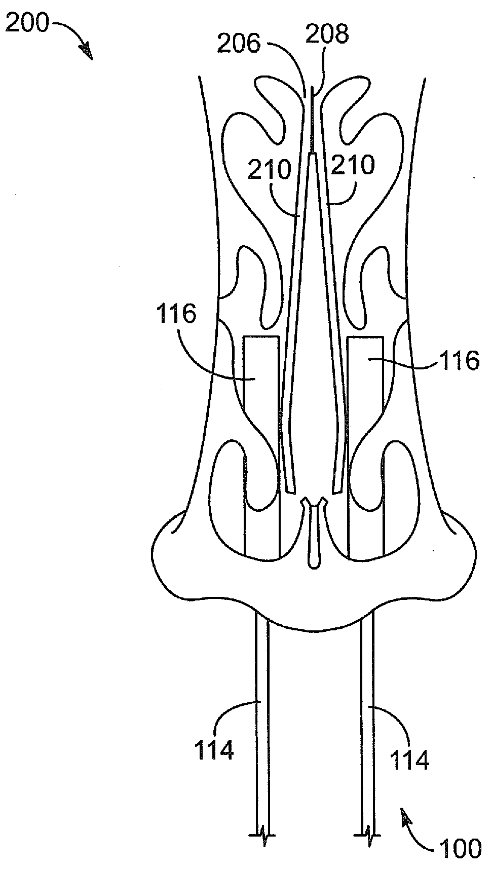 Apparatus, system, and method for middle turbinate medializer