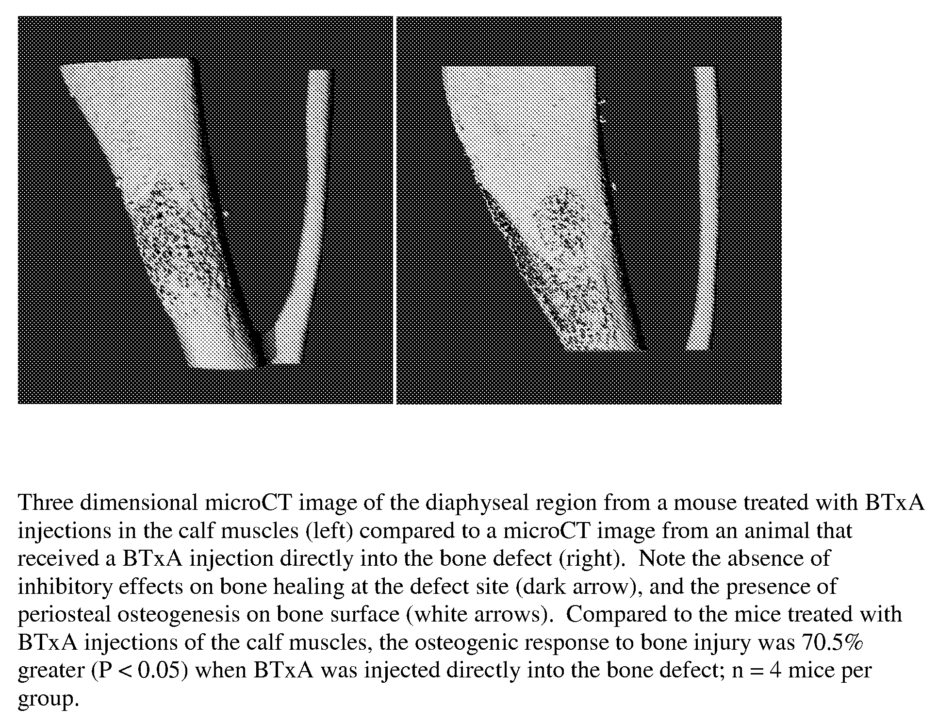 Inhibition of pathological bone formation