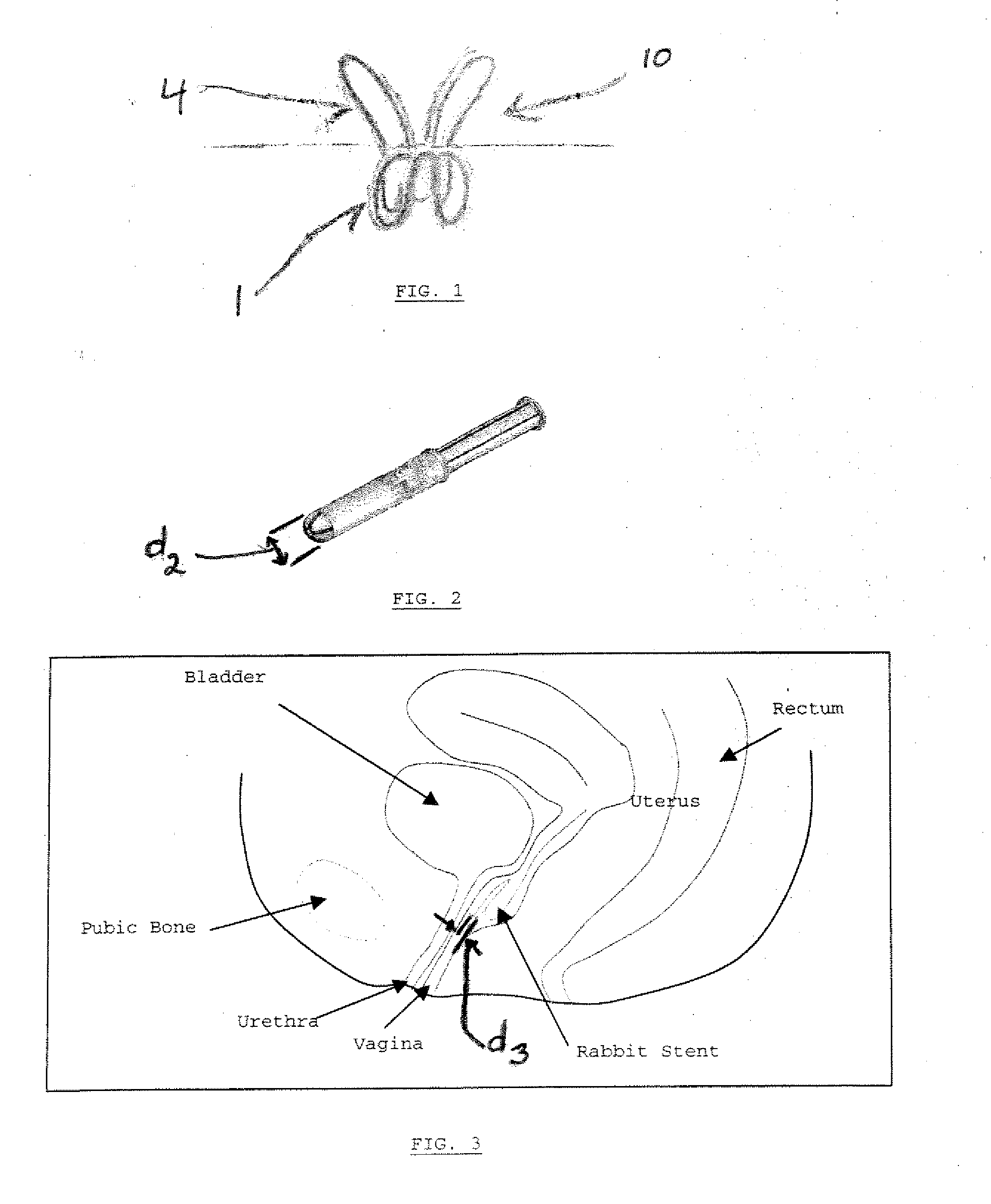 Method of treating urinary incontinence