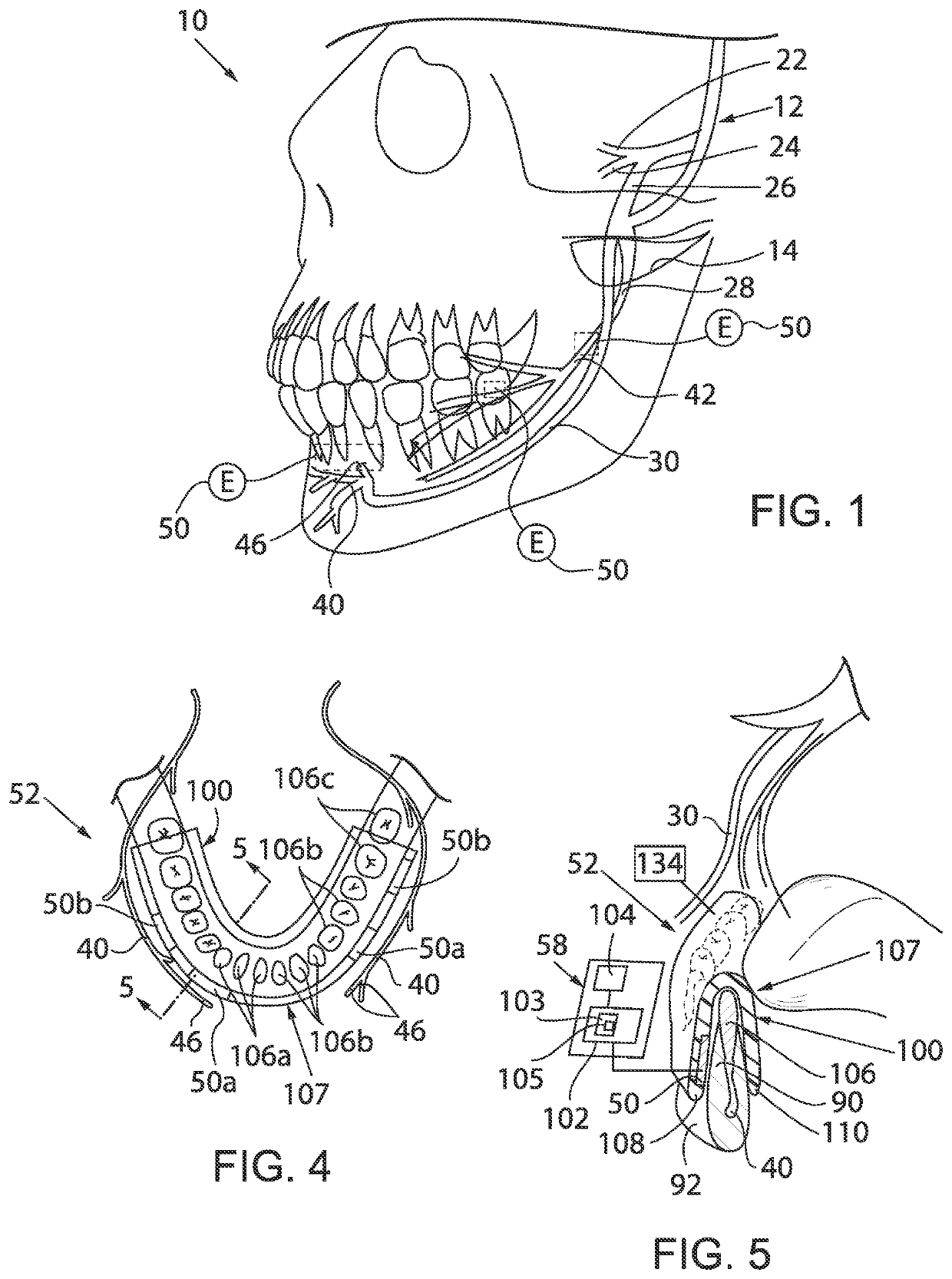 Penetration of Cerebral Spinal Fluid into the Brain Parenchyma Using Temporally Patterned Neuromodulation