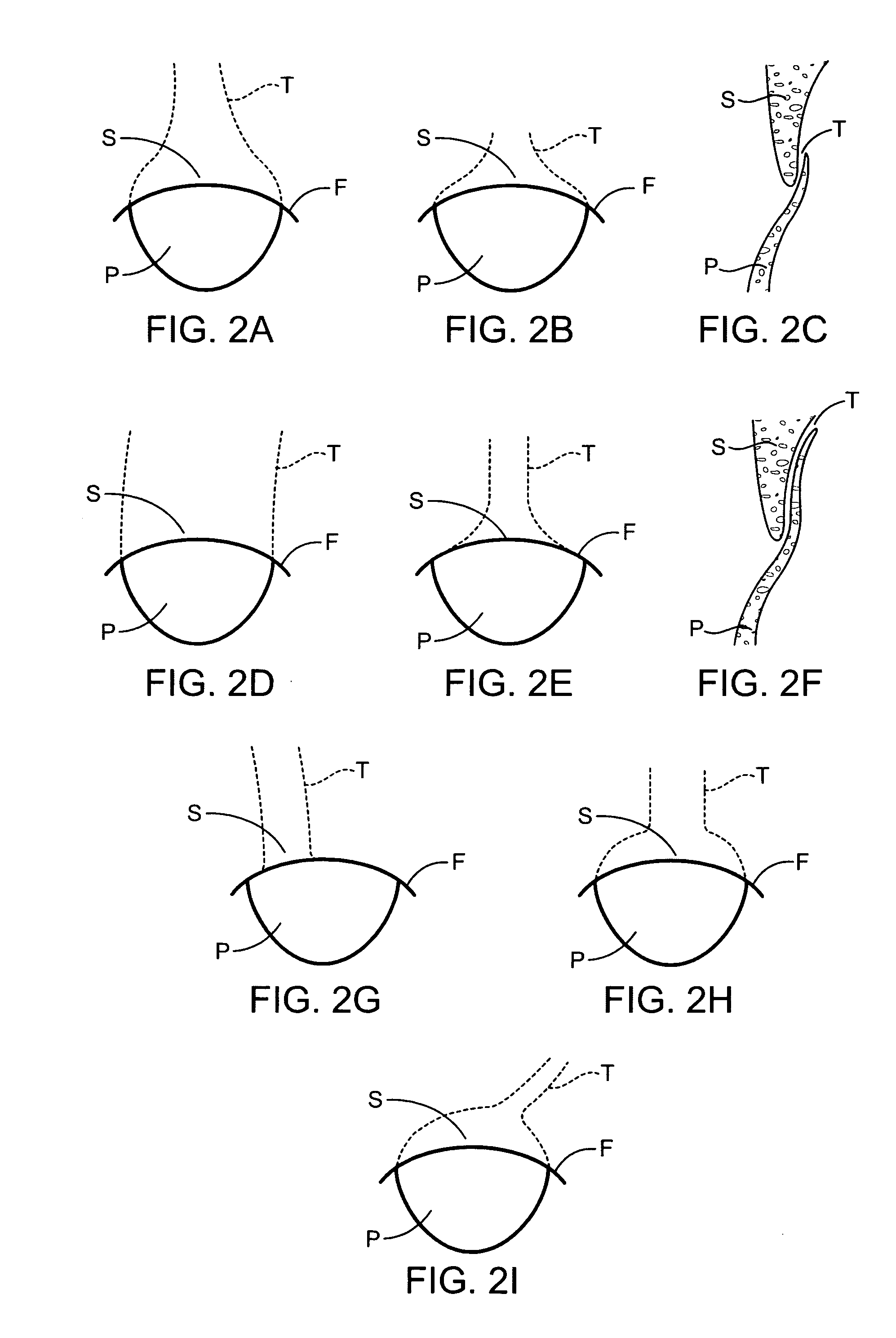 Methods and apparatus to achieve a closure of a layered tissue defect