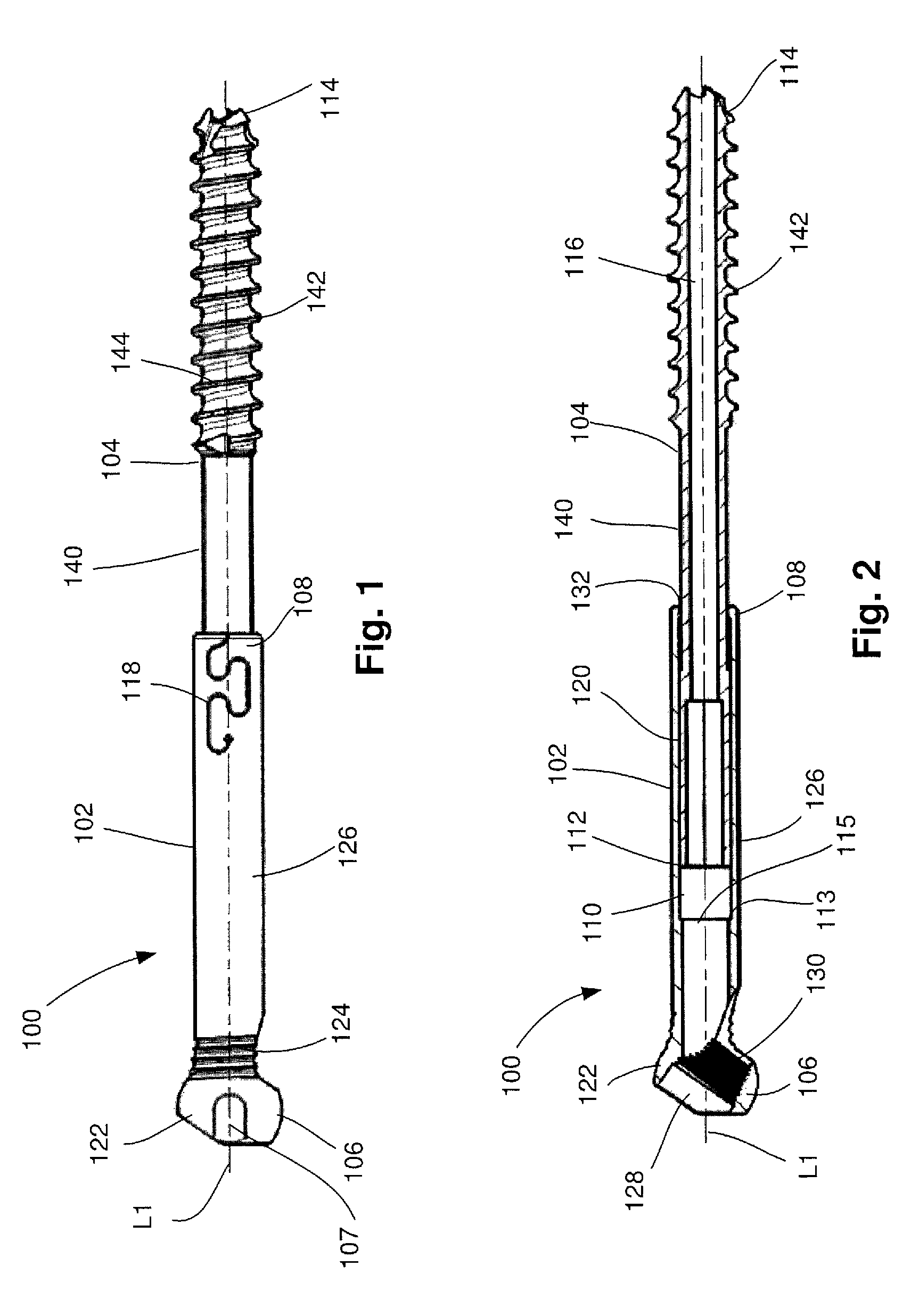 Telescoping screw for femoral neck fractures