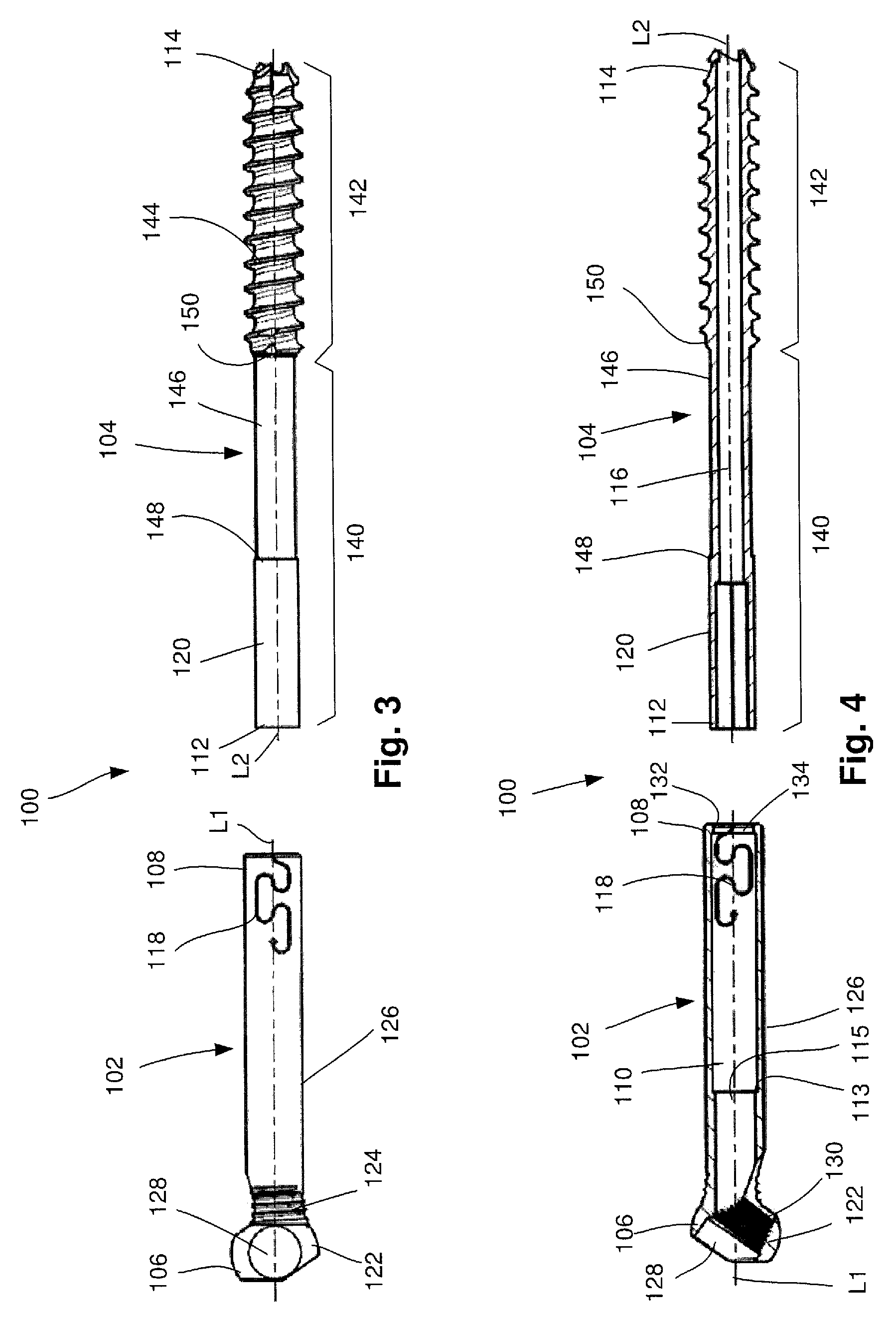 Telescoping screw for femoral neck fractures