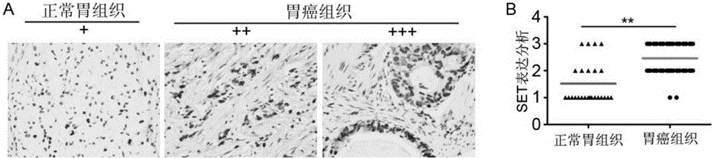 Application of SET gene in preparing product for diagnosing and/or treating gastric cancer