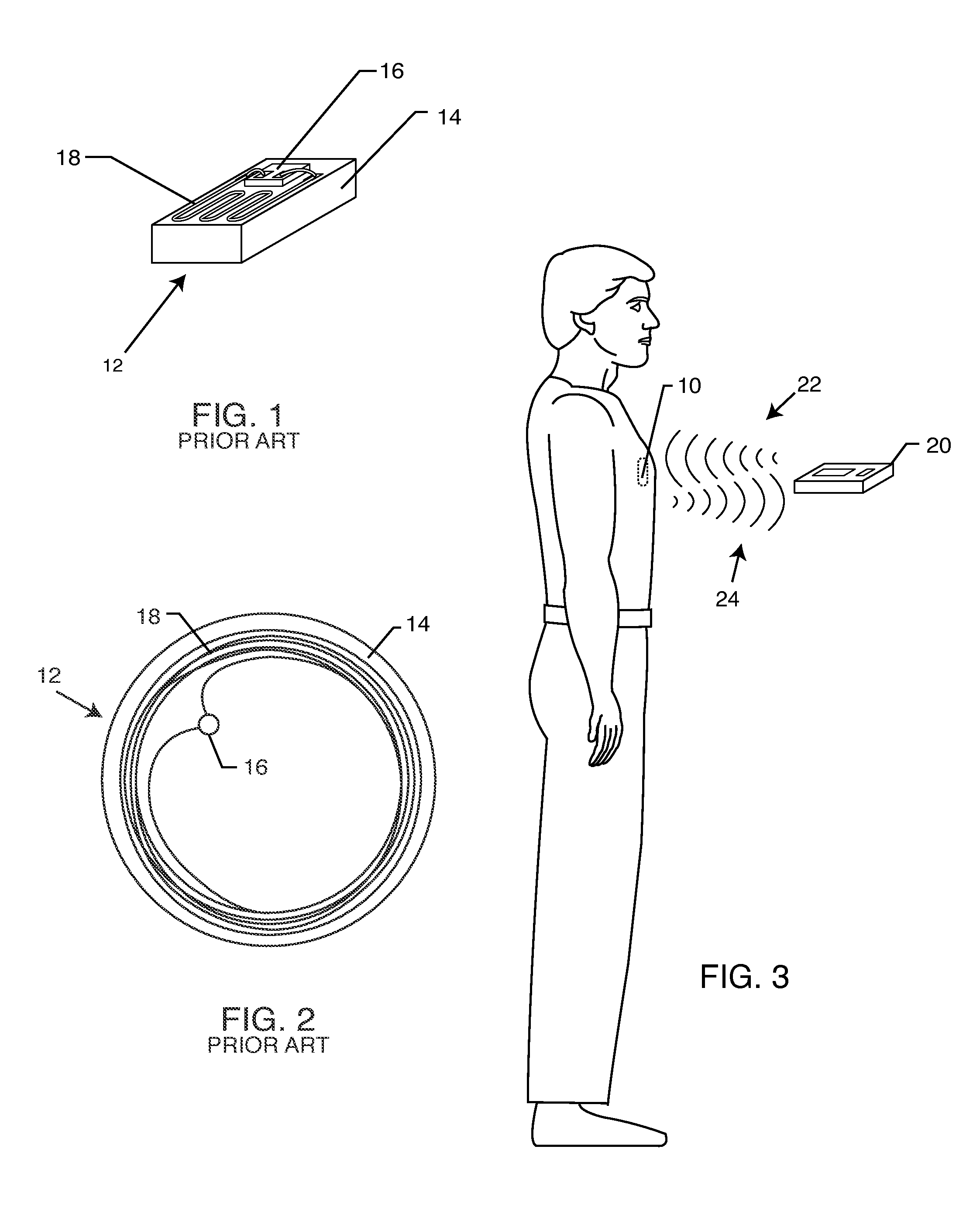 Hermetically sealed RFID microelectronic chip connected to a biocompatible RFID antenna