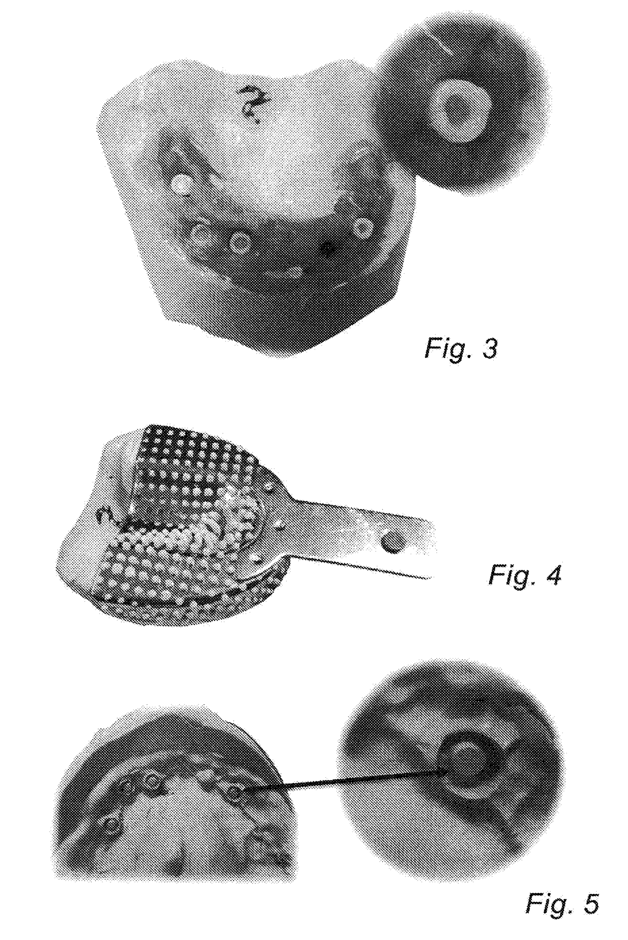 Dental implant procedure by scanning a closed tray impression