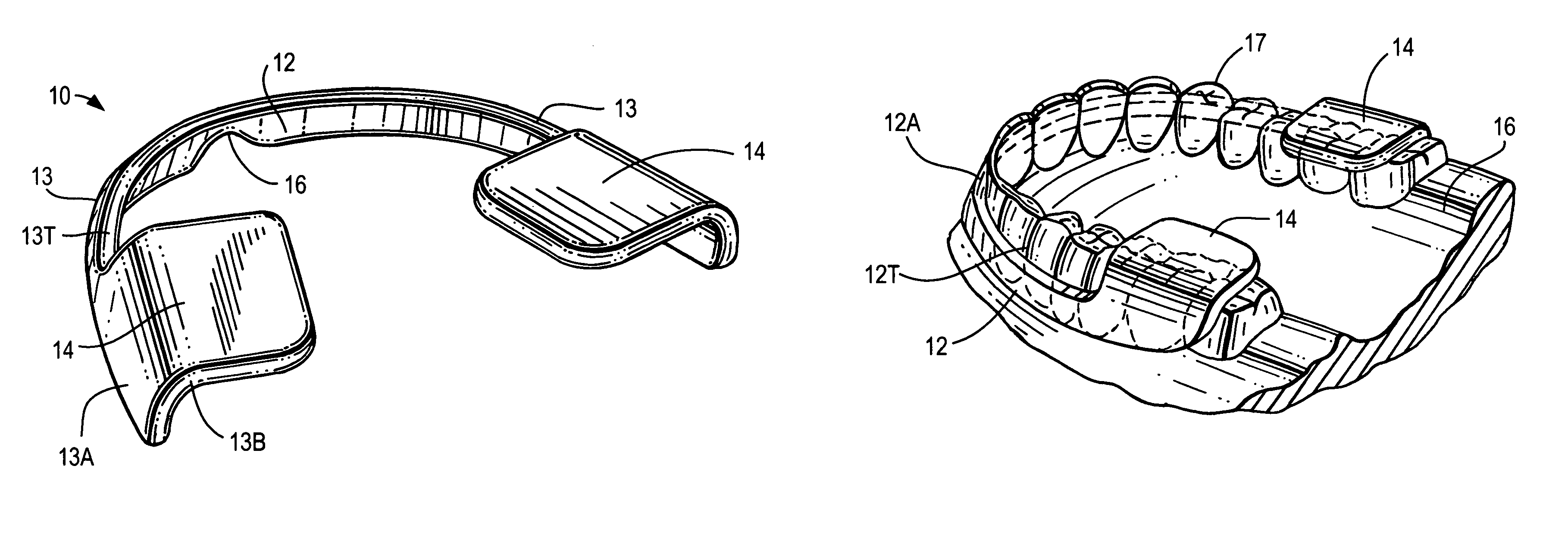 Bruxism protective device