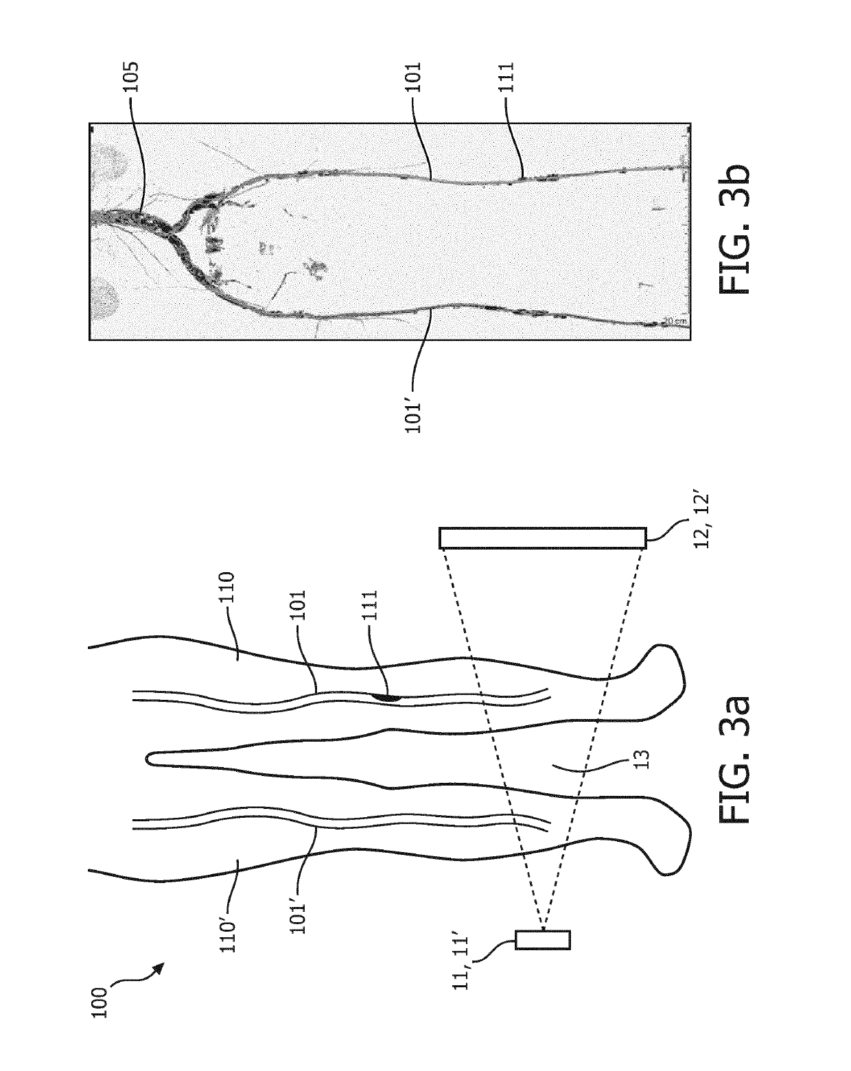 Stenosis assessment