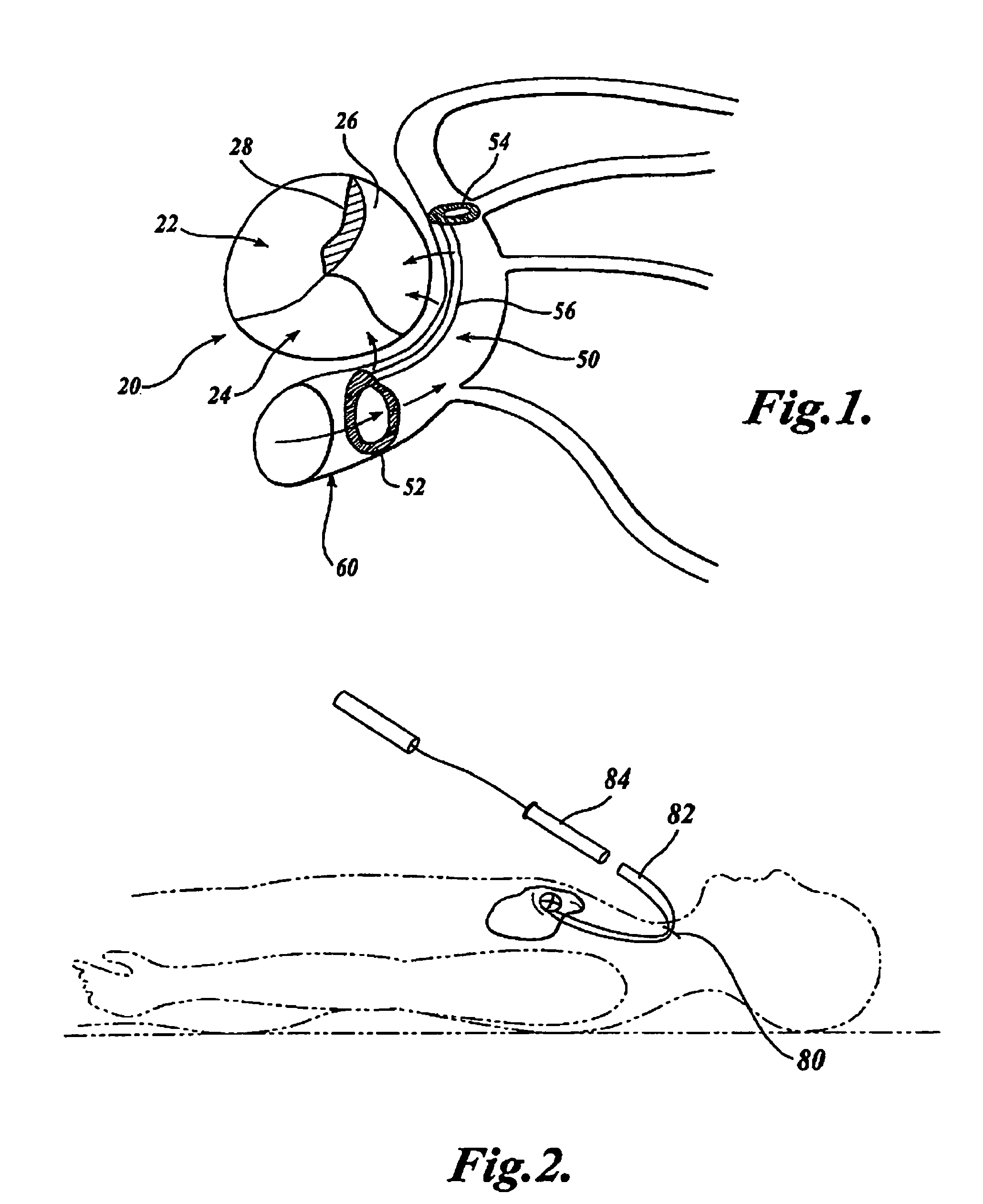 Device and method for modifying the shape of a body organ