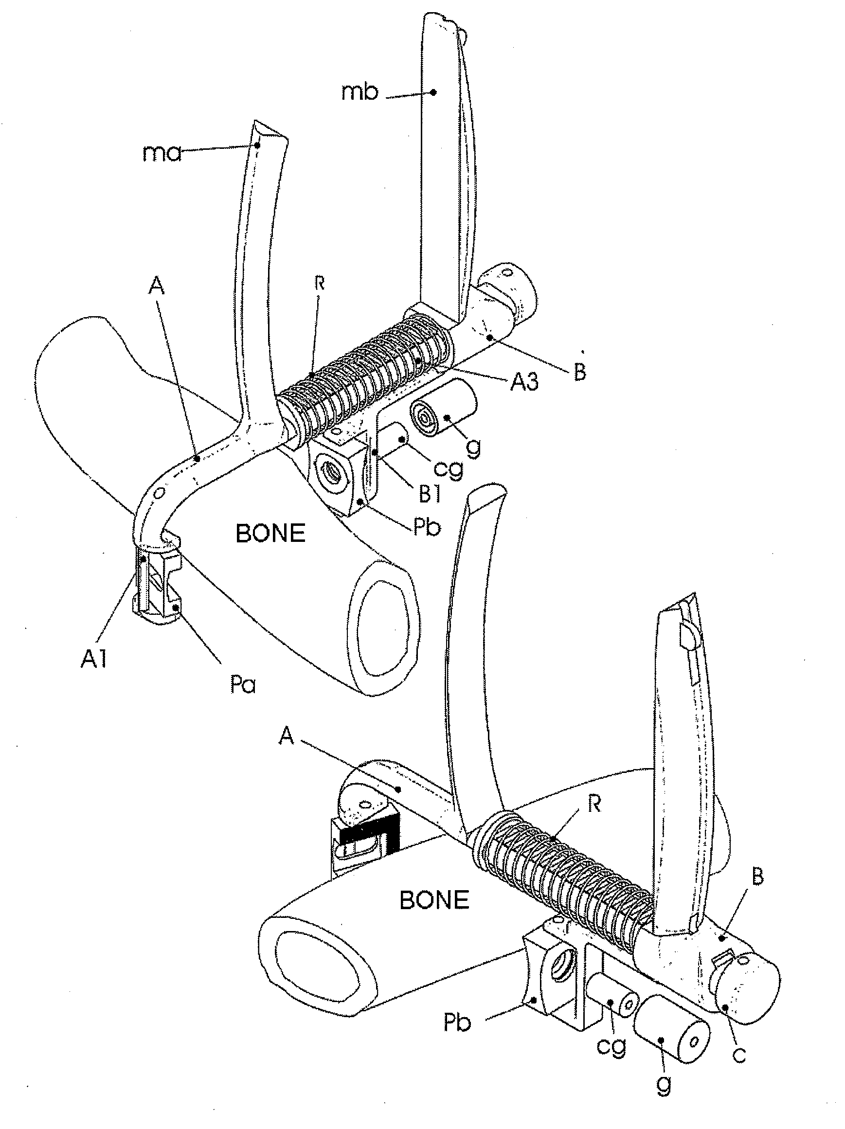 Device for fixing screws in osteoporotic bones