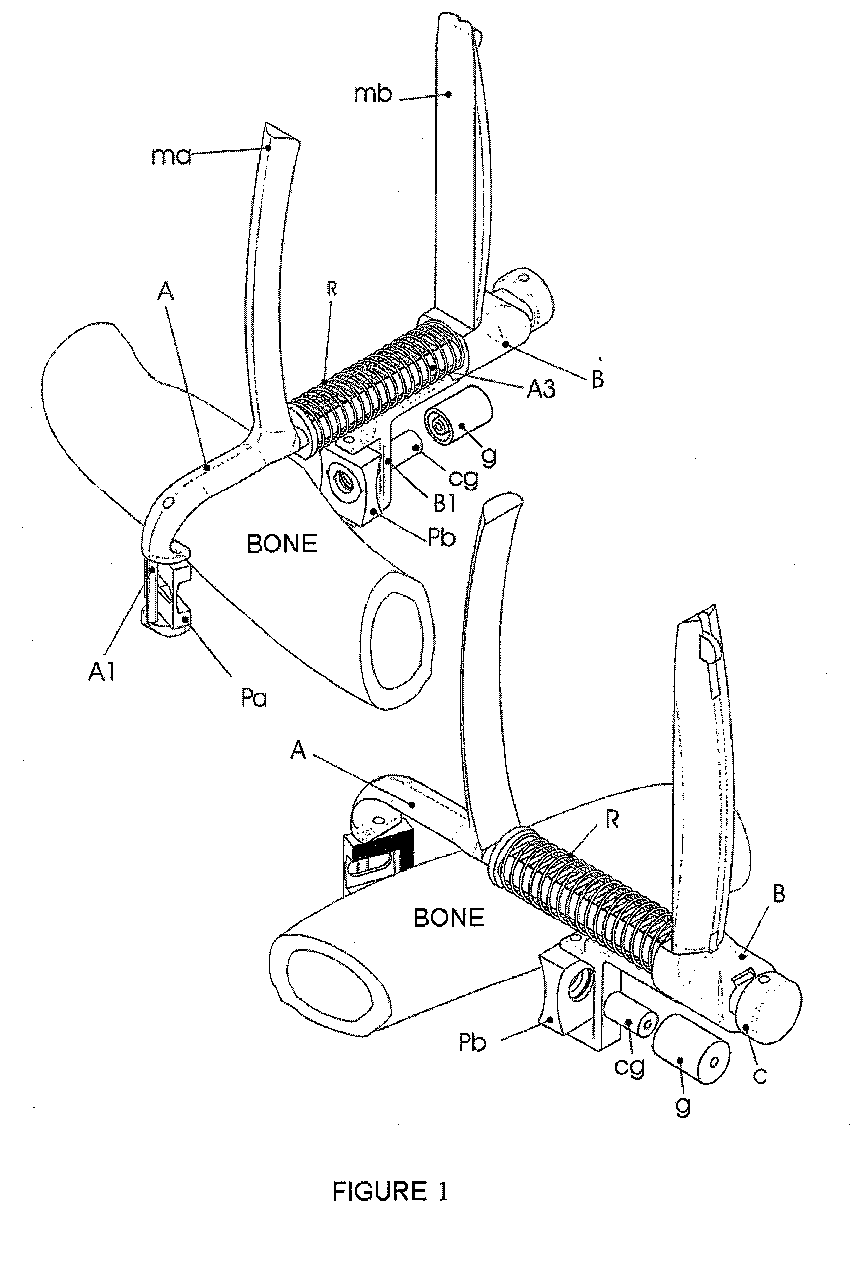 Device for fixing screws in osteoporotic bones