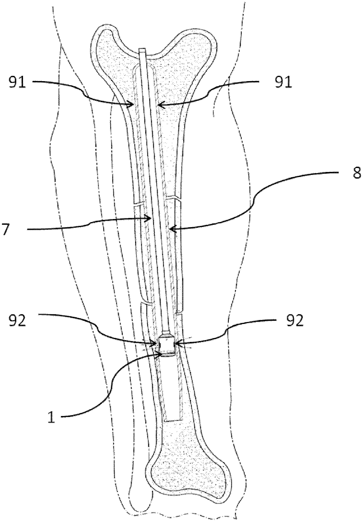 Side lighting device engaged with medullary cavity guide needle