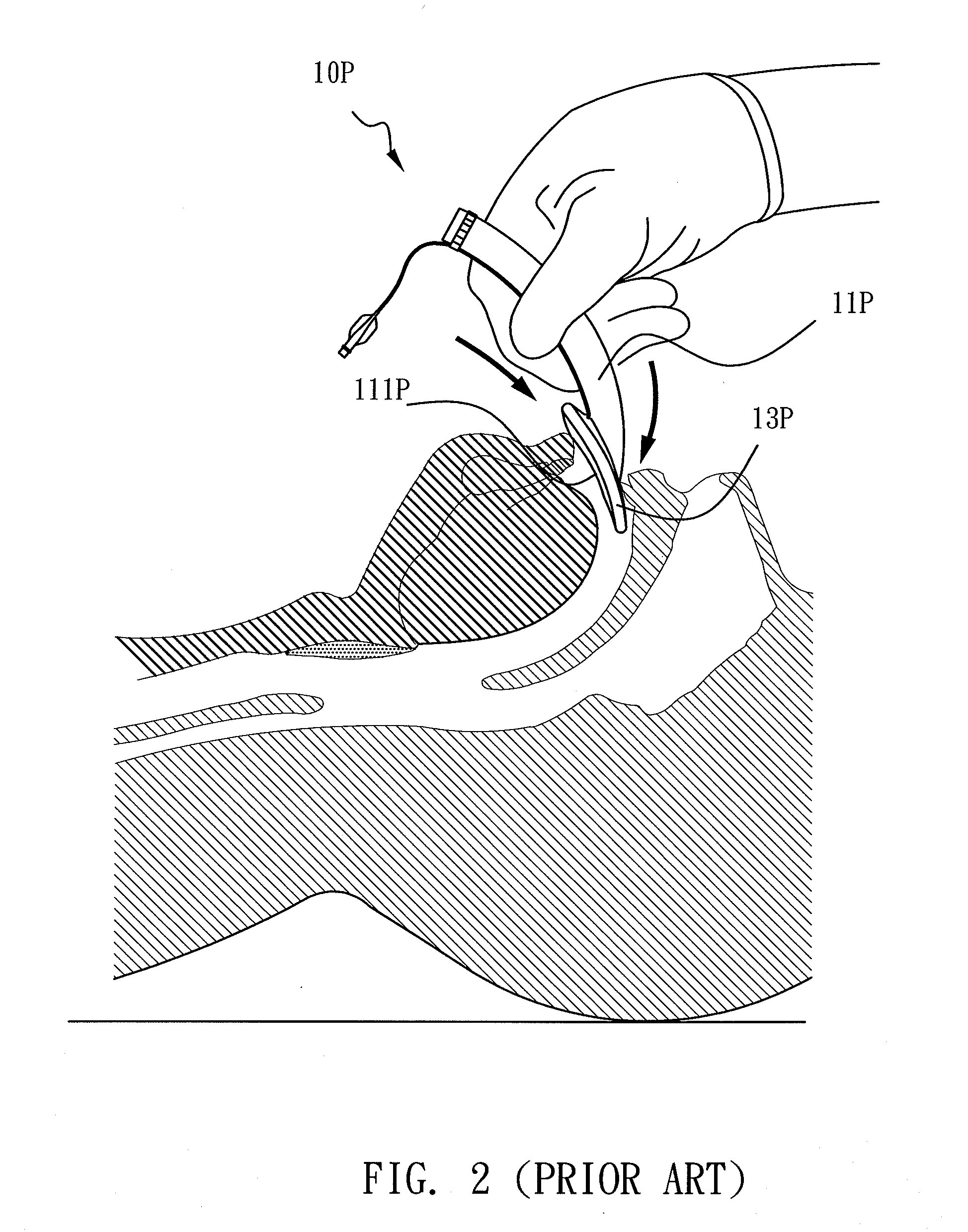 Laryngeal Mask Airway Installation Kit, Clip Device, and Laryngeal Mask Airway