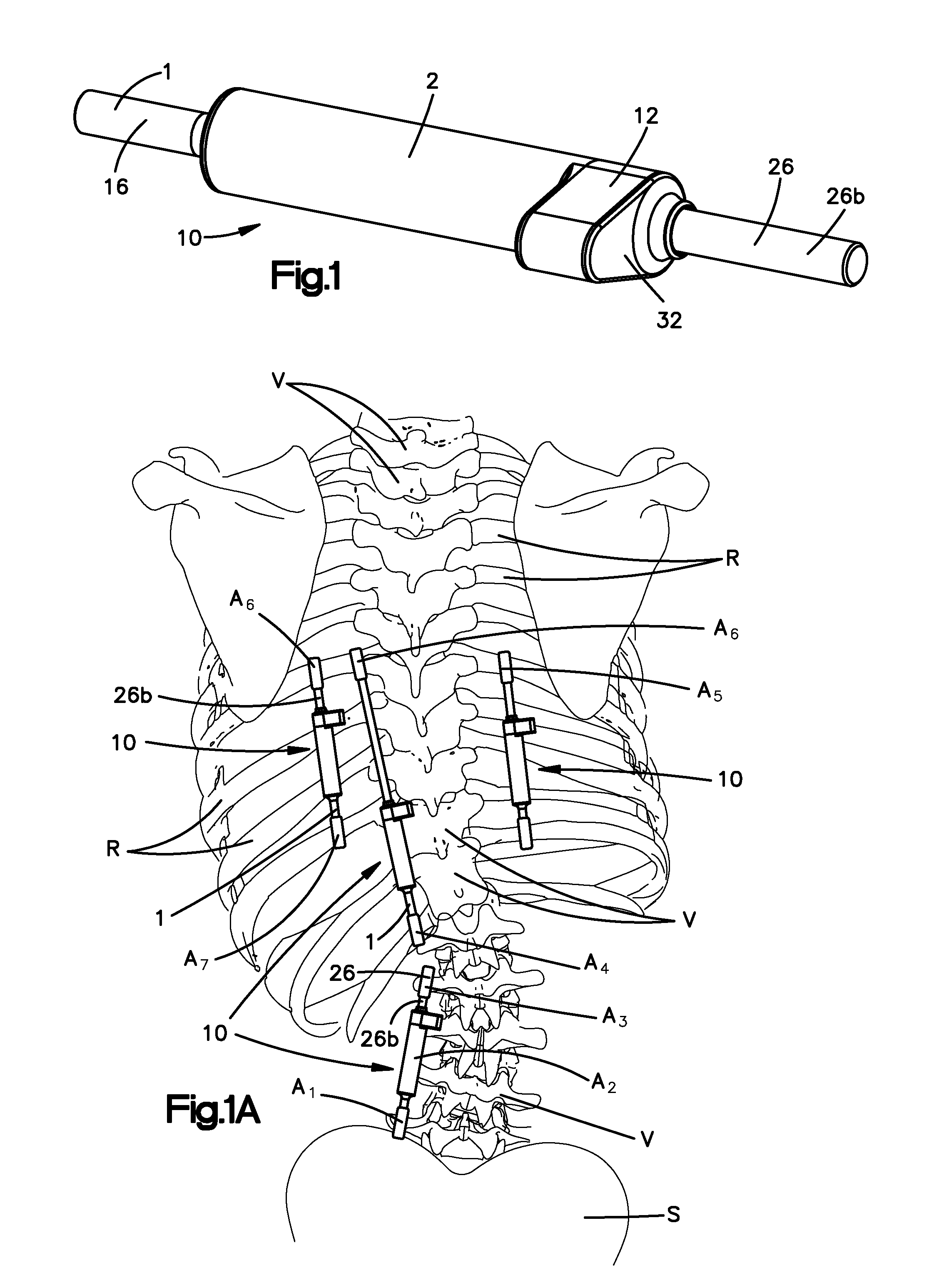 Non-fusion scoliosis expandable spinal rod