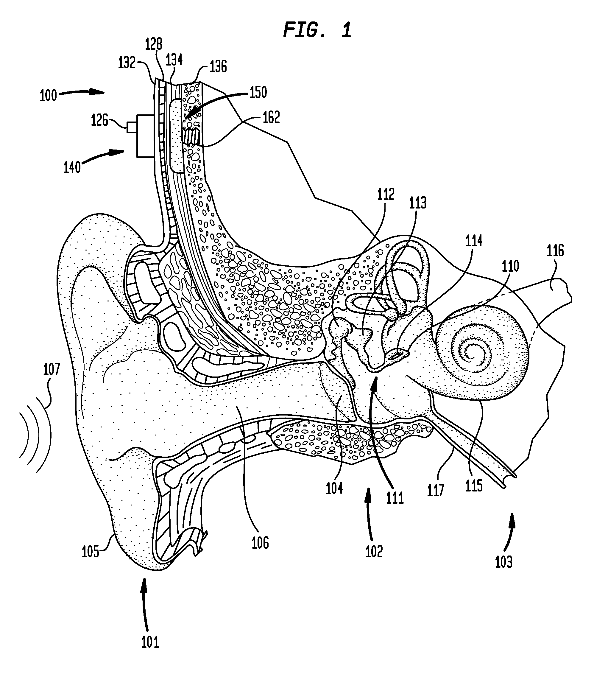 Implantable component of a hearing prosthesis