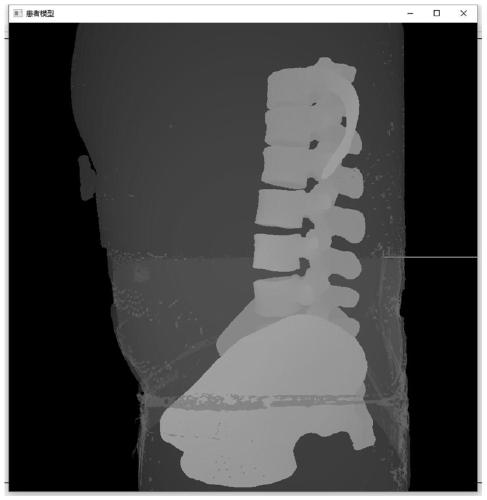 Real-time visual navigation system in orthopaedic minimally invasive surgery based on virtual-real fusion