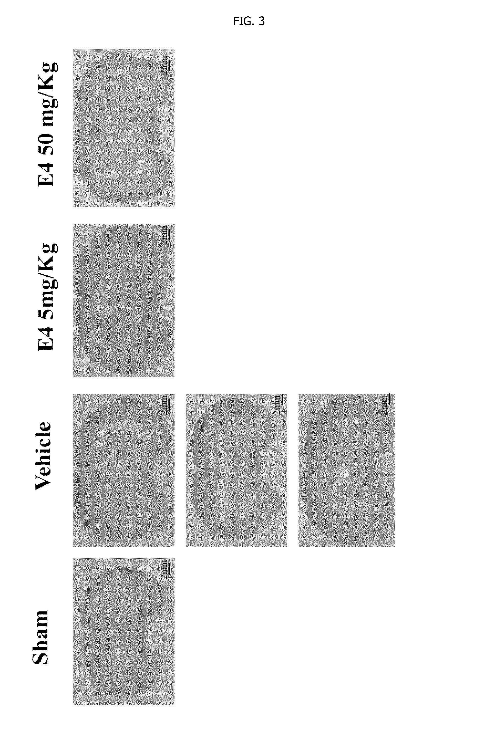 Estrogenic components for use in the treatment of neurological disorders