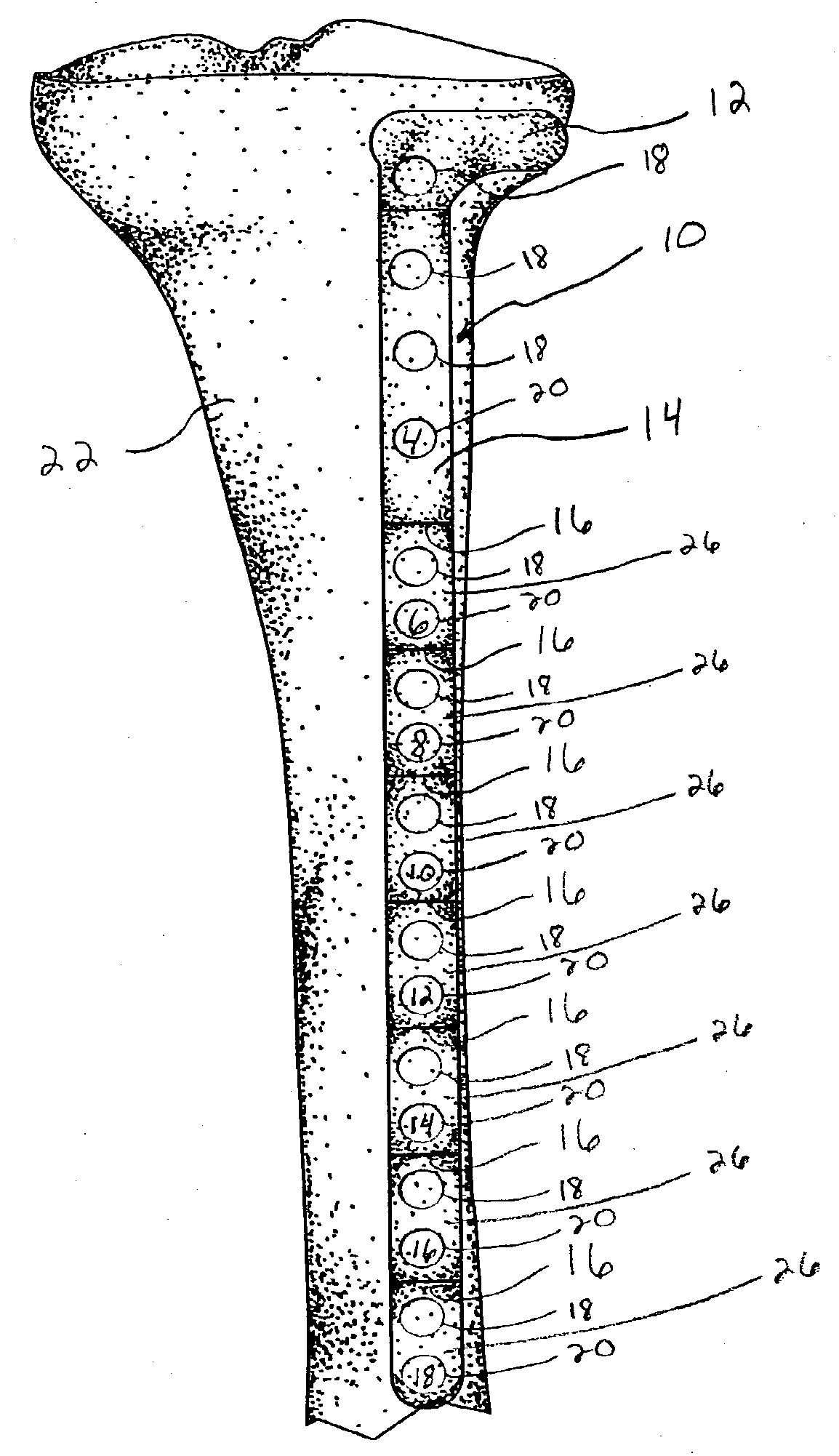 Provisional bone plate