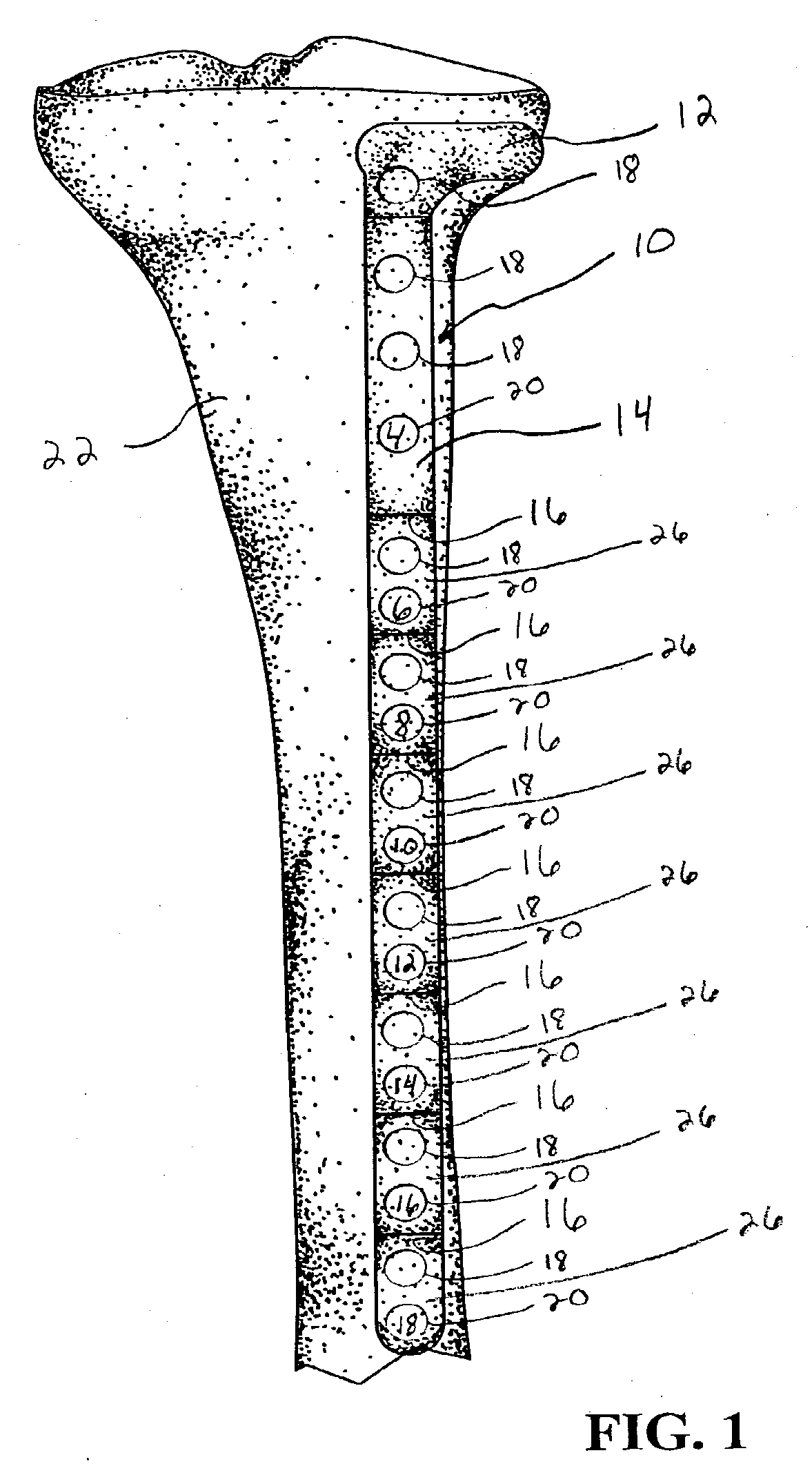 Provisional bone plate