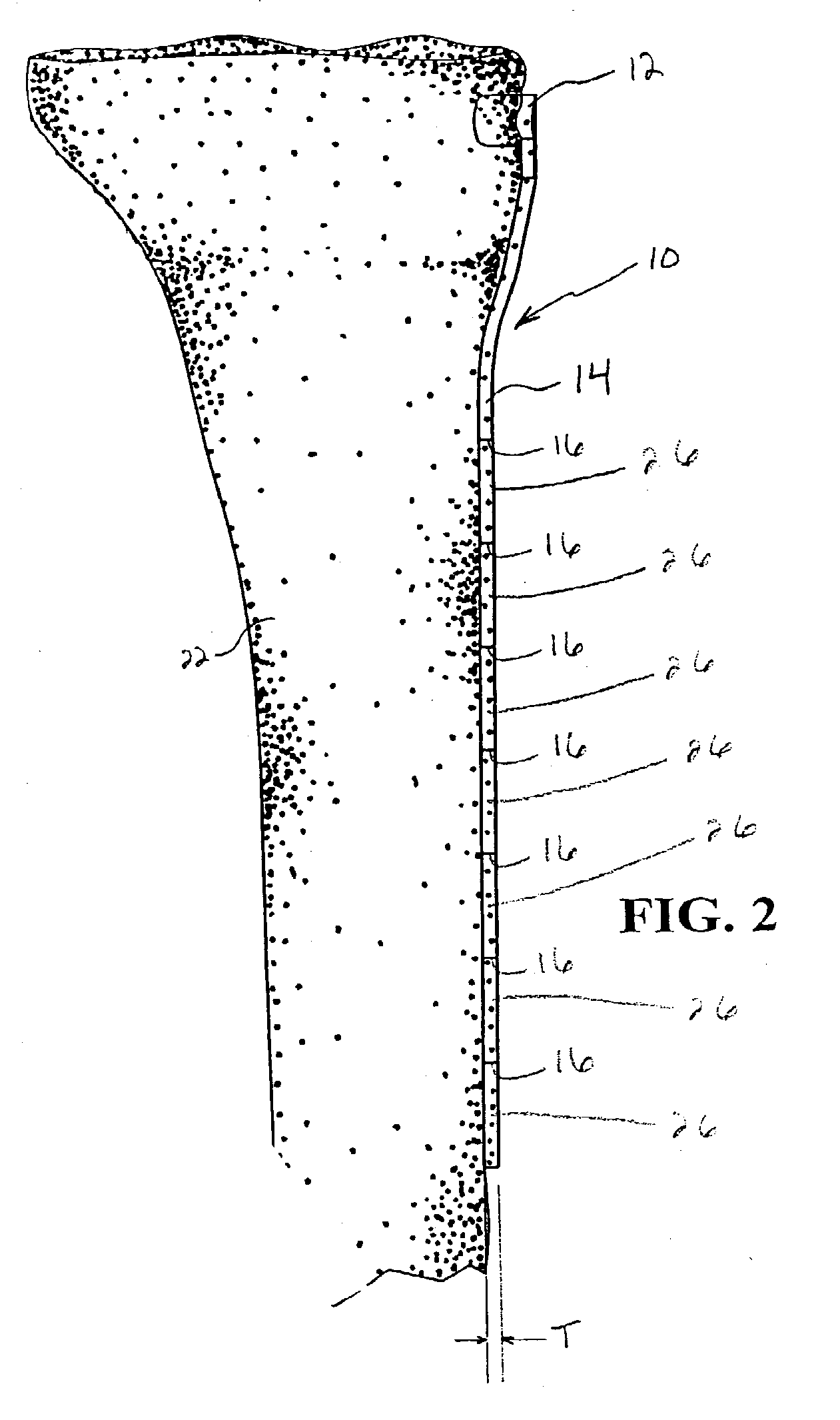 Provisional bone plate