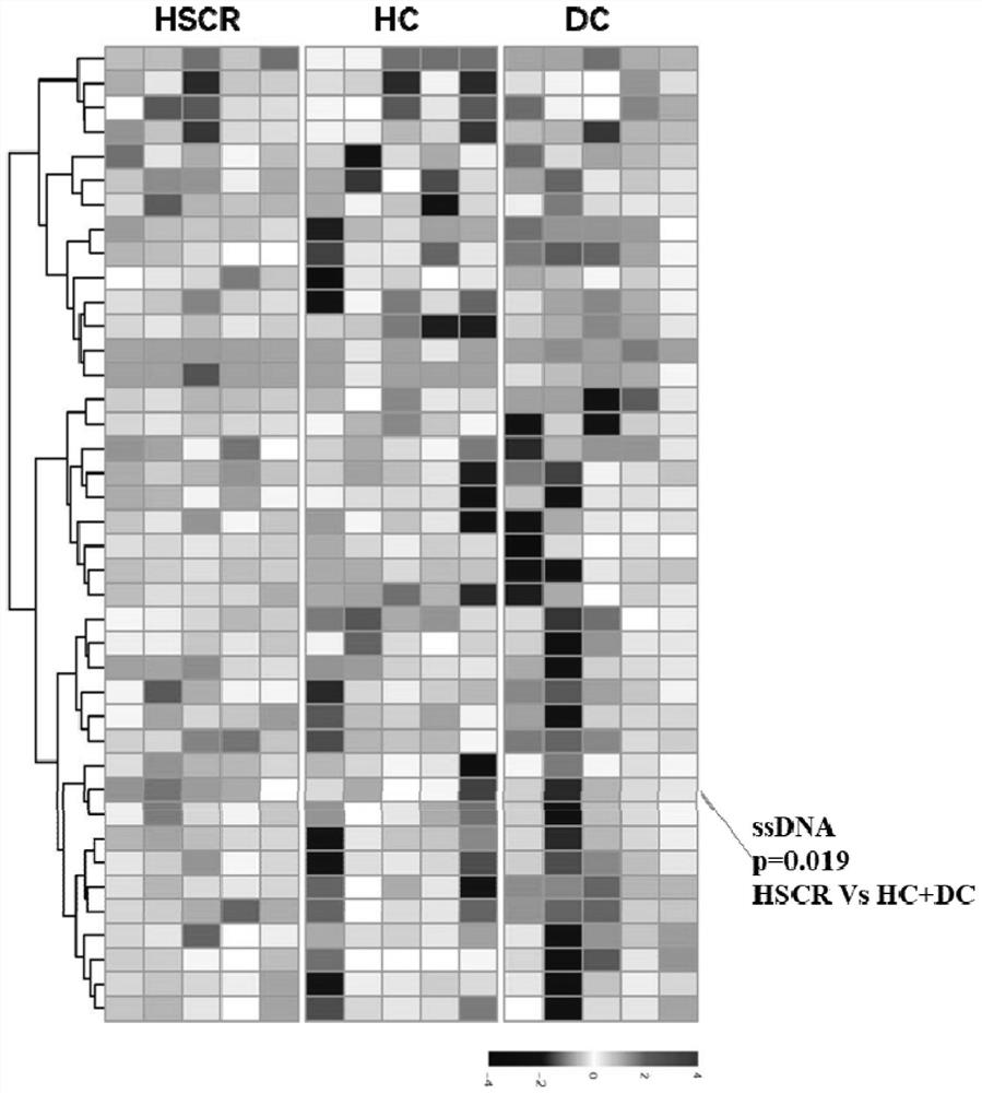 Application of anti-single-stranded DNA antibody as congenital megacolon diagnostic marker