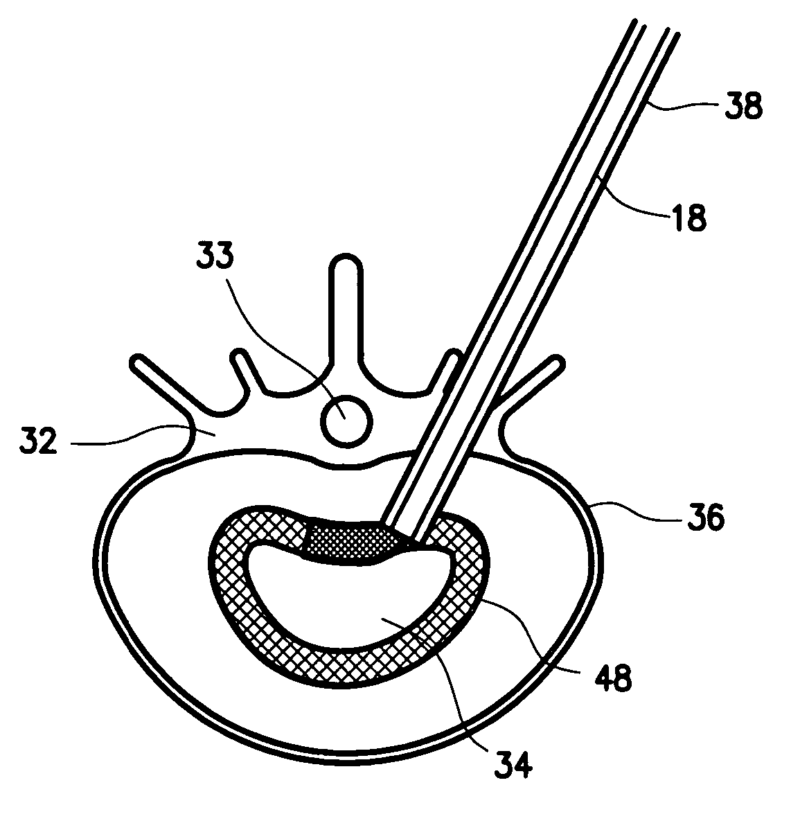 Mechanical apparatus and method for artificial disc replacement