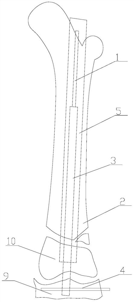 Intramedullary nail special for children and use method thereof