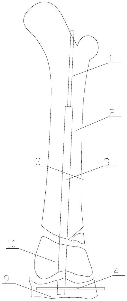 Intramedullary nail special for children and use method thereof