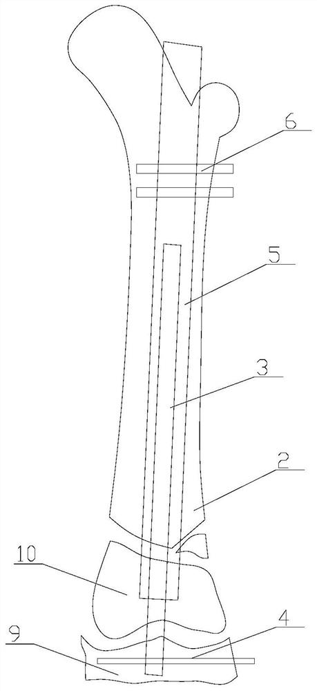 Intramedullary nail special for children and use method thereof