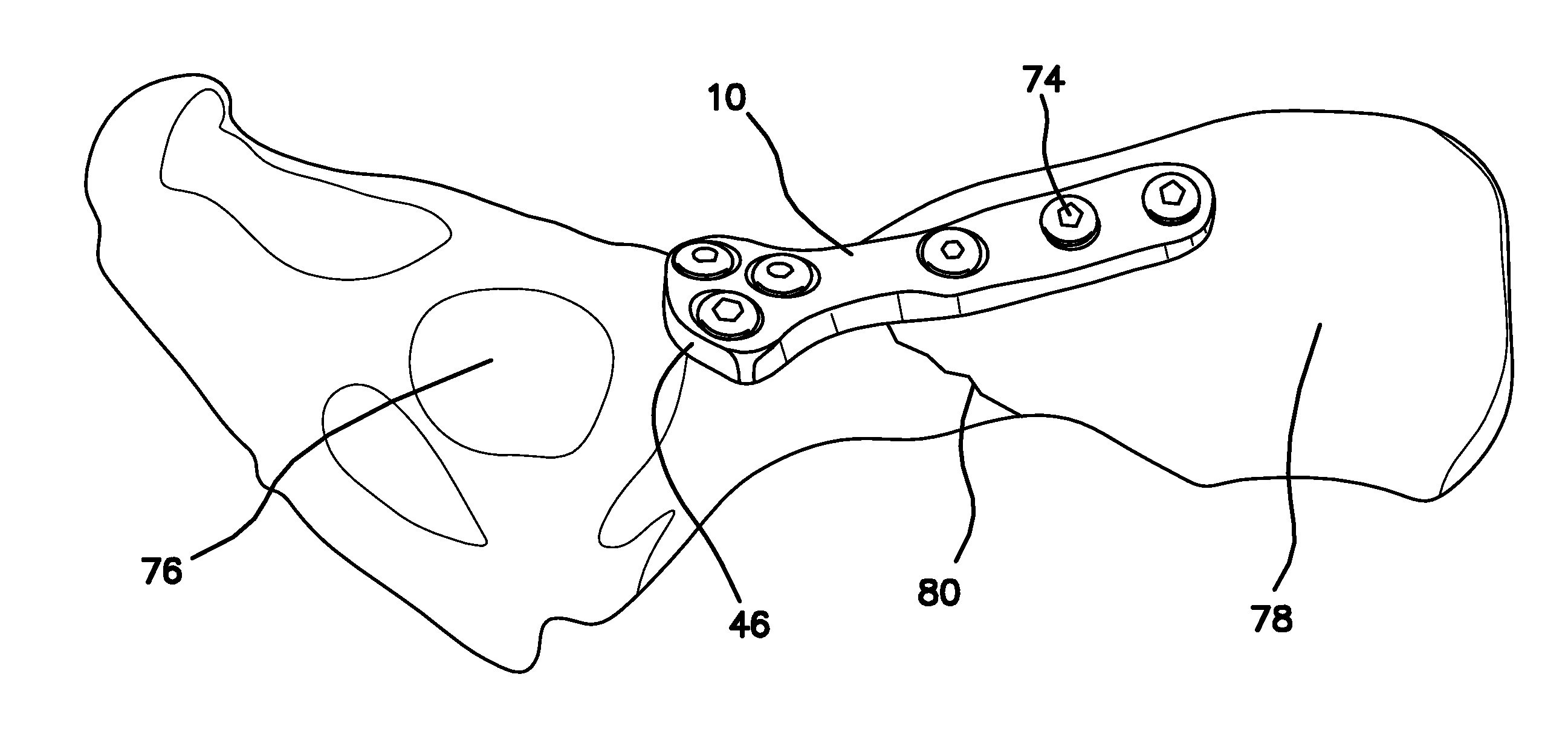 Universal Surgical Plate with 30 Degree Compression Angle