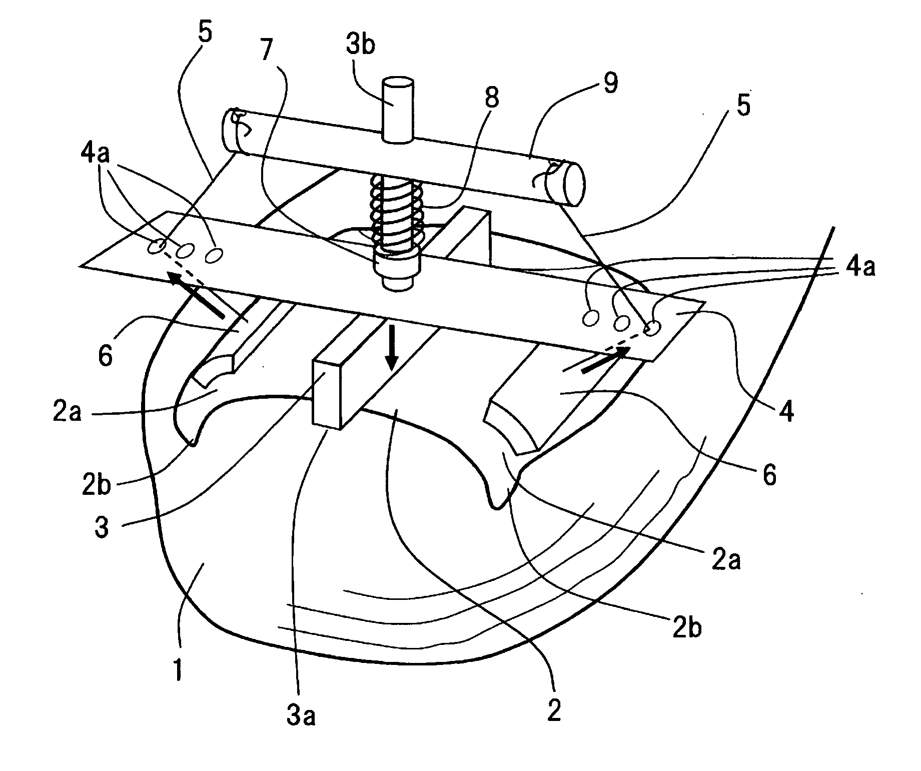 Apparatus for Correcting an Ingrown Nail