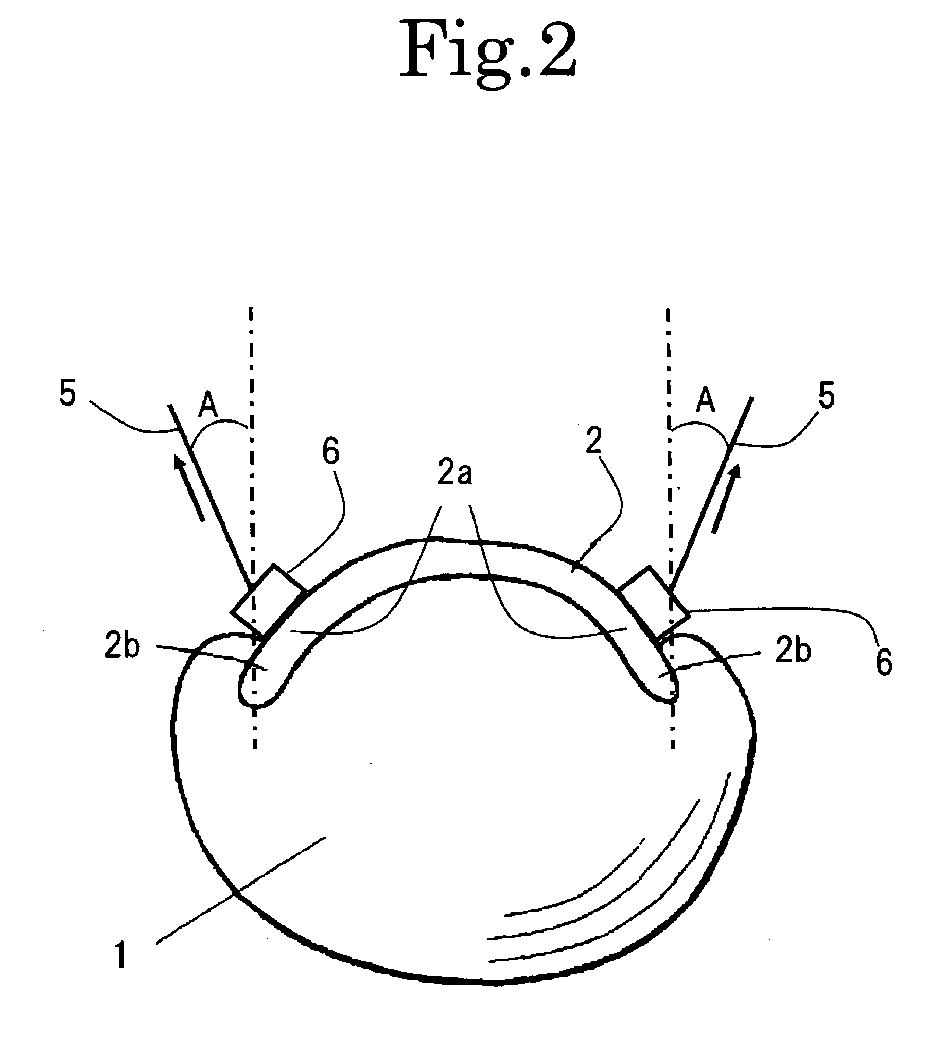 Apparatus for Correcting an Ingrown Nail