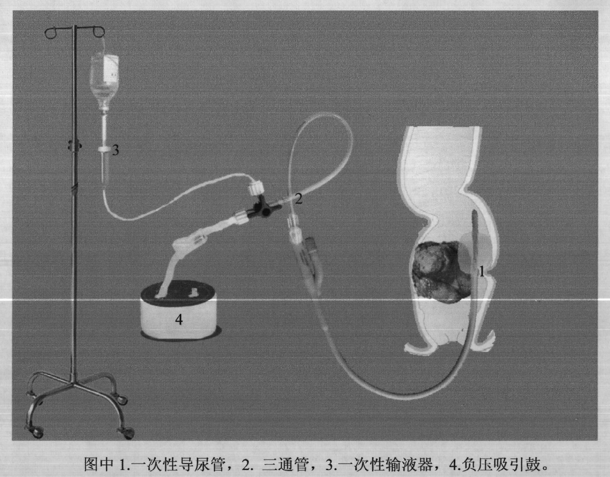 Defecating apparatus for removing intestinal obstruction