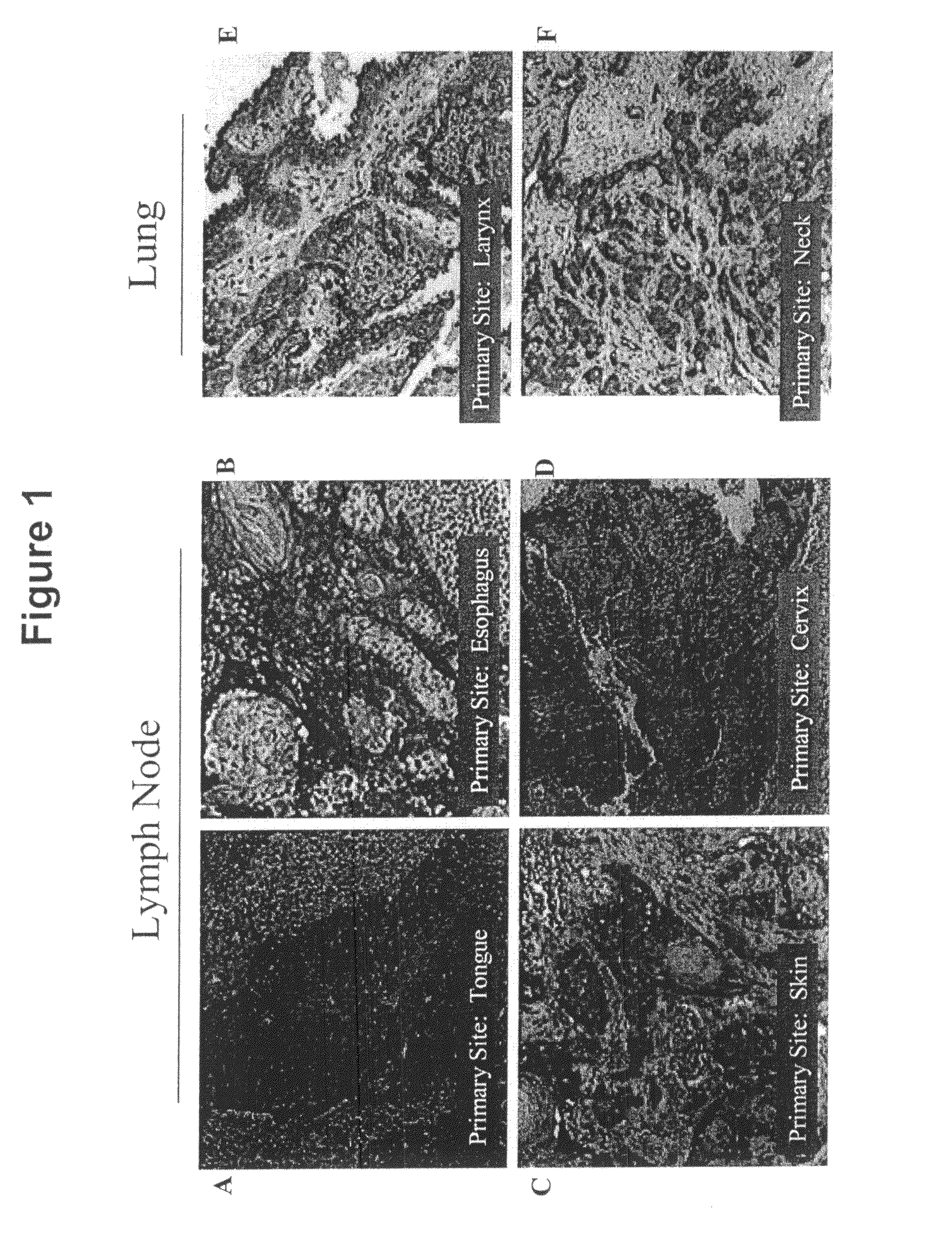 Compositions and methods for inhibiting growth of smad4-deficient cancers