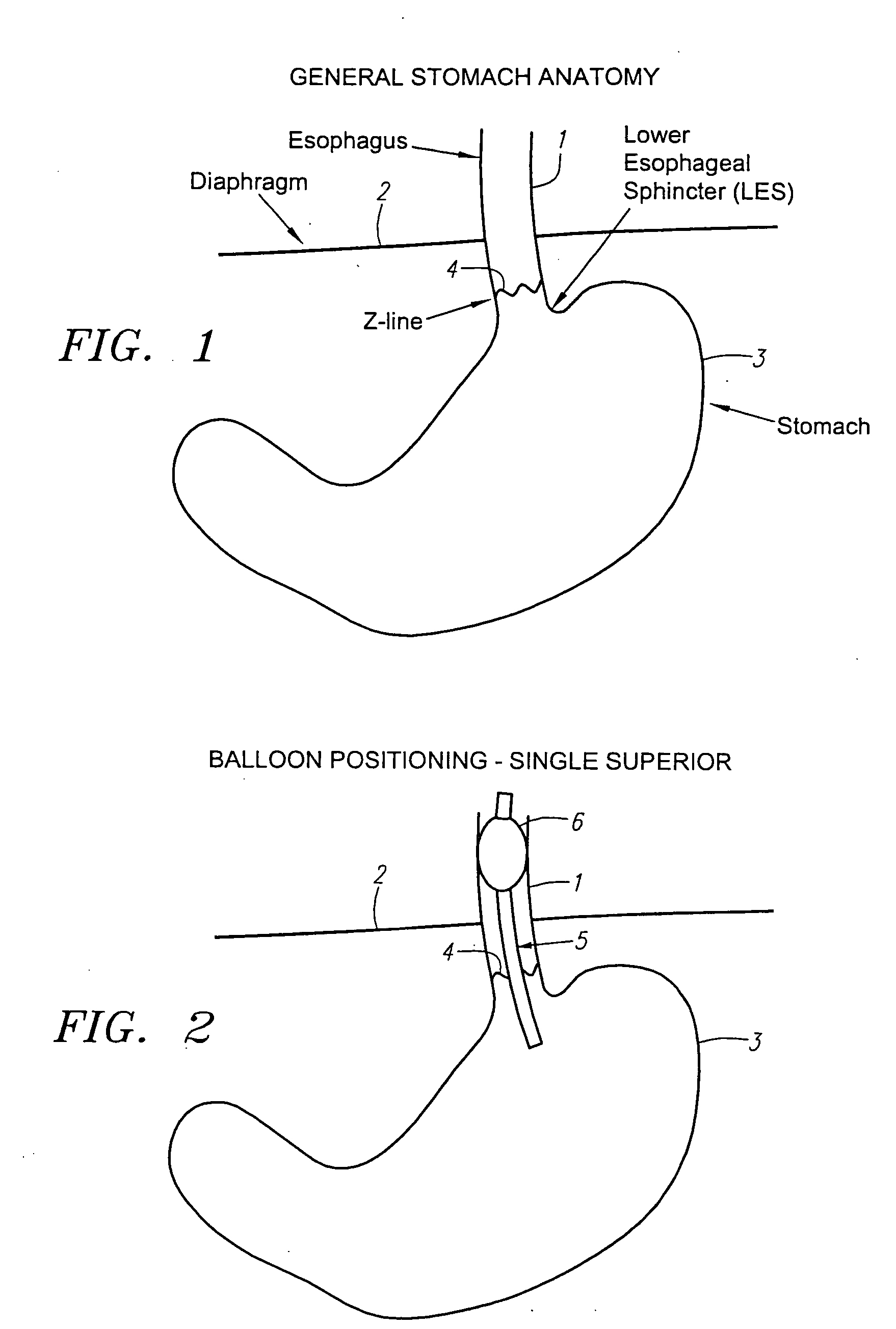 Method of using endoscopic truncal vagoscopy with gastric bypass, gastric banding and other procedures