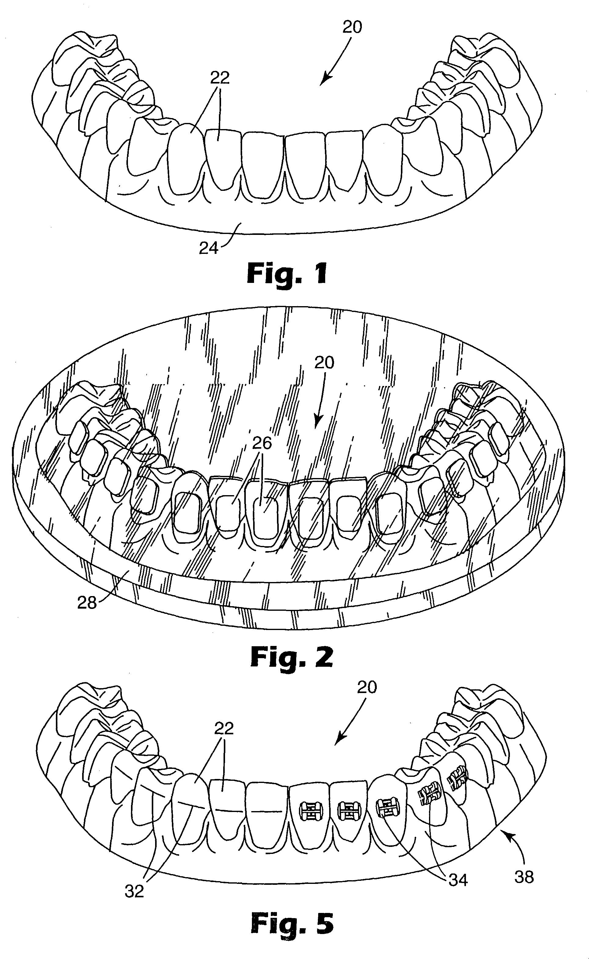 Orthodontic appliances having a contoured bonding surface